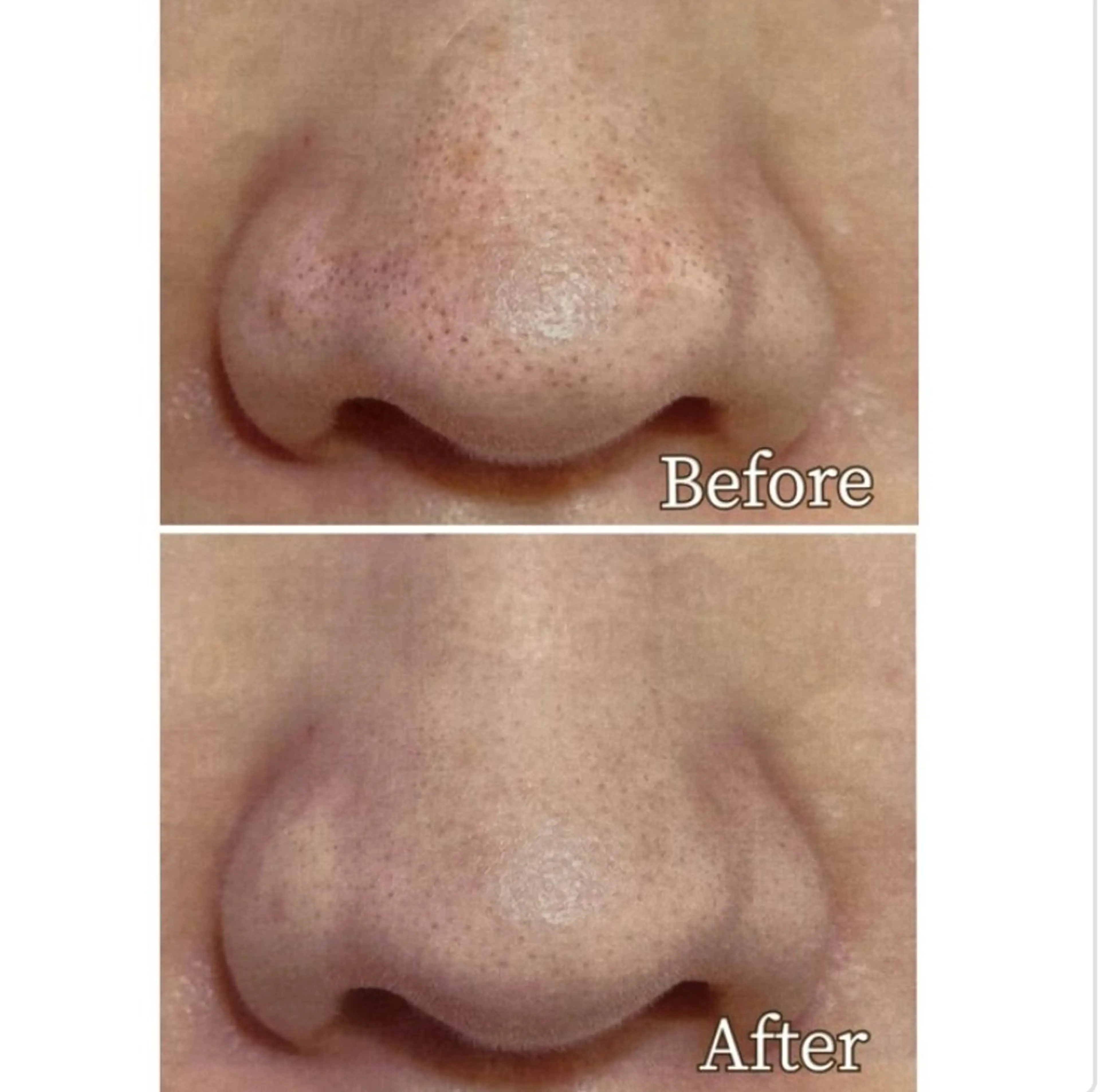 ⭐︎黒ずみ毛穴撃退⭐︎ 肌質改善　毛穴洗浄✨の写真