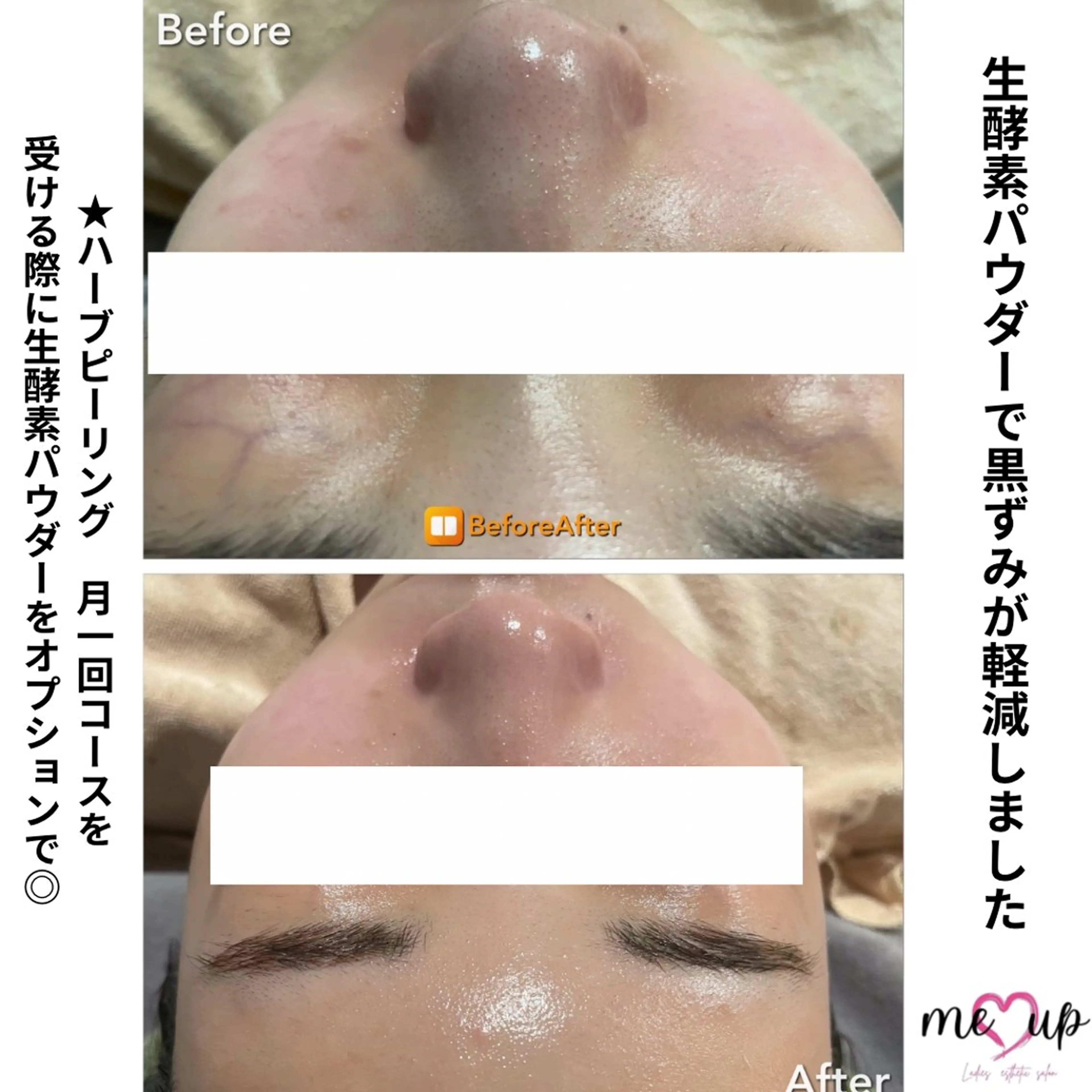 エステ Meupニキビ専門店 背中/ハーブ/肌管理のその他イメージ