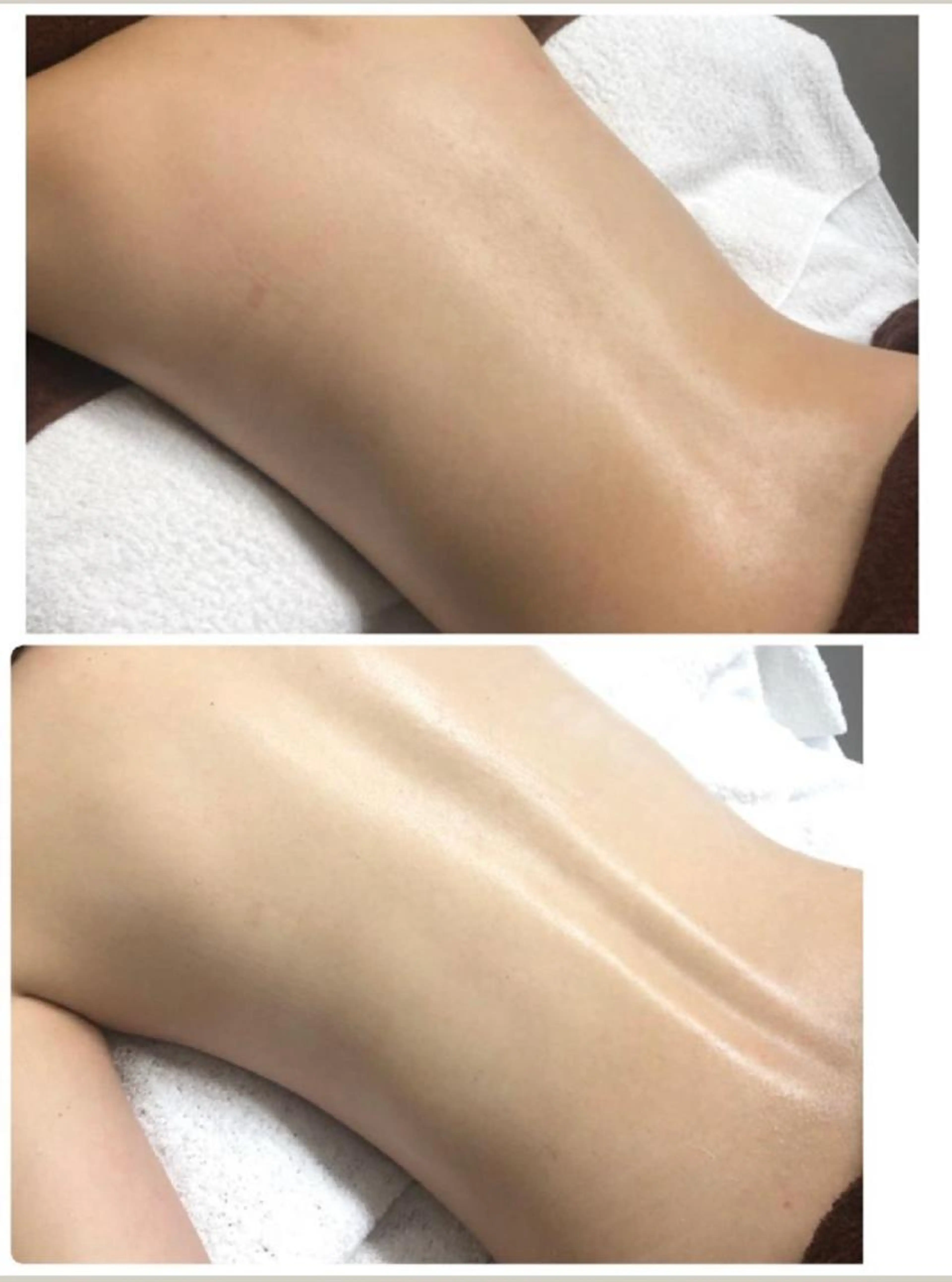 ☆初回限定☆🌿剥けないハーブピーリング🌿【お背中】90分　通常26,500円→3500円！の写真