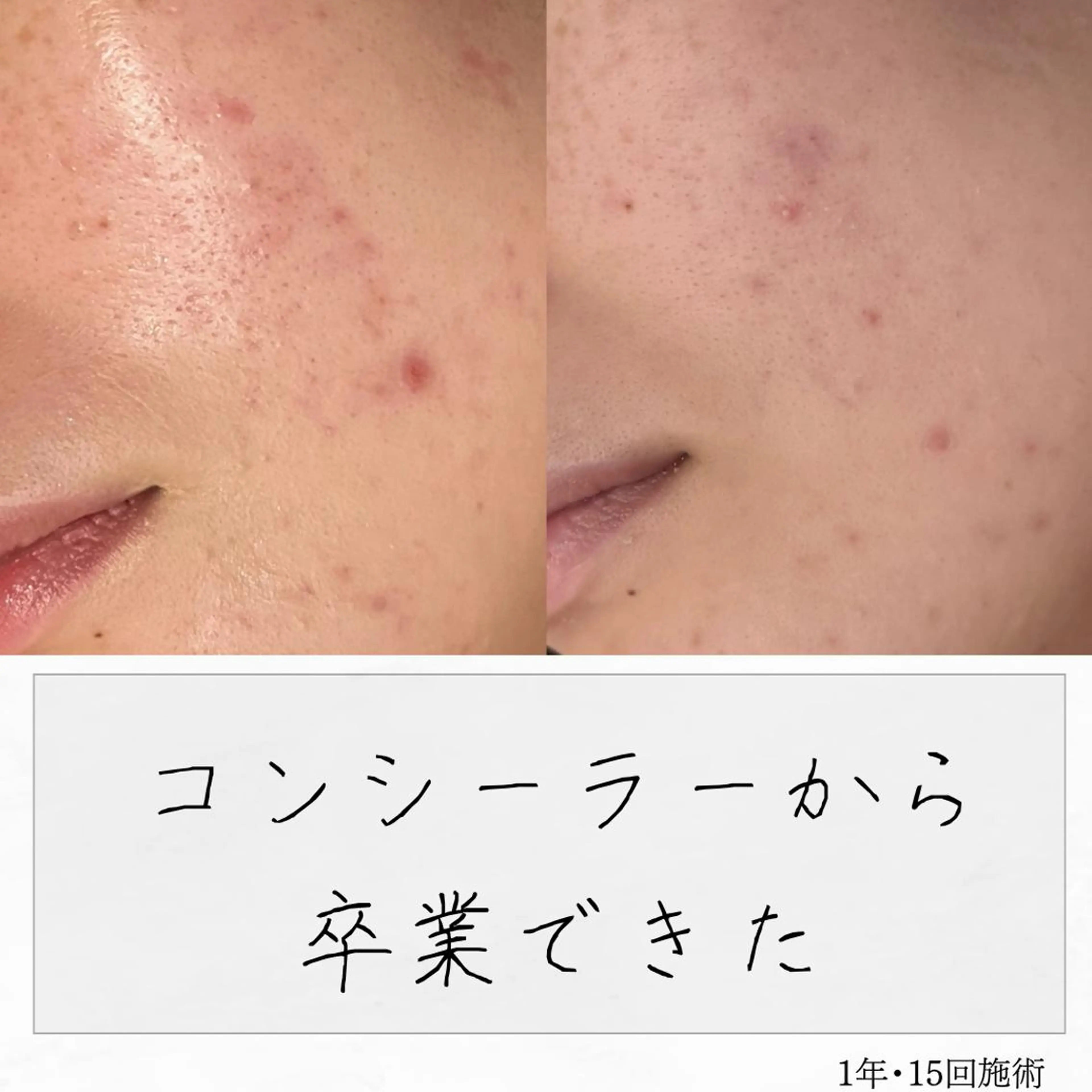 ニキビ経験者が施術 する専門サロン🌻のエステ・リラクイメージ