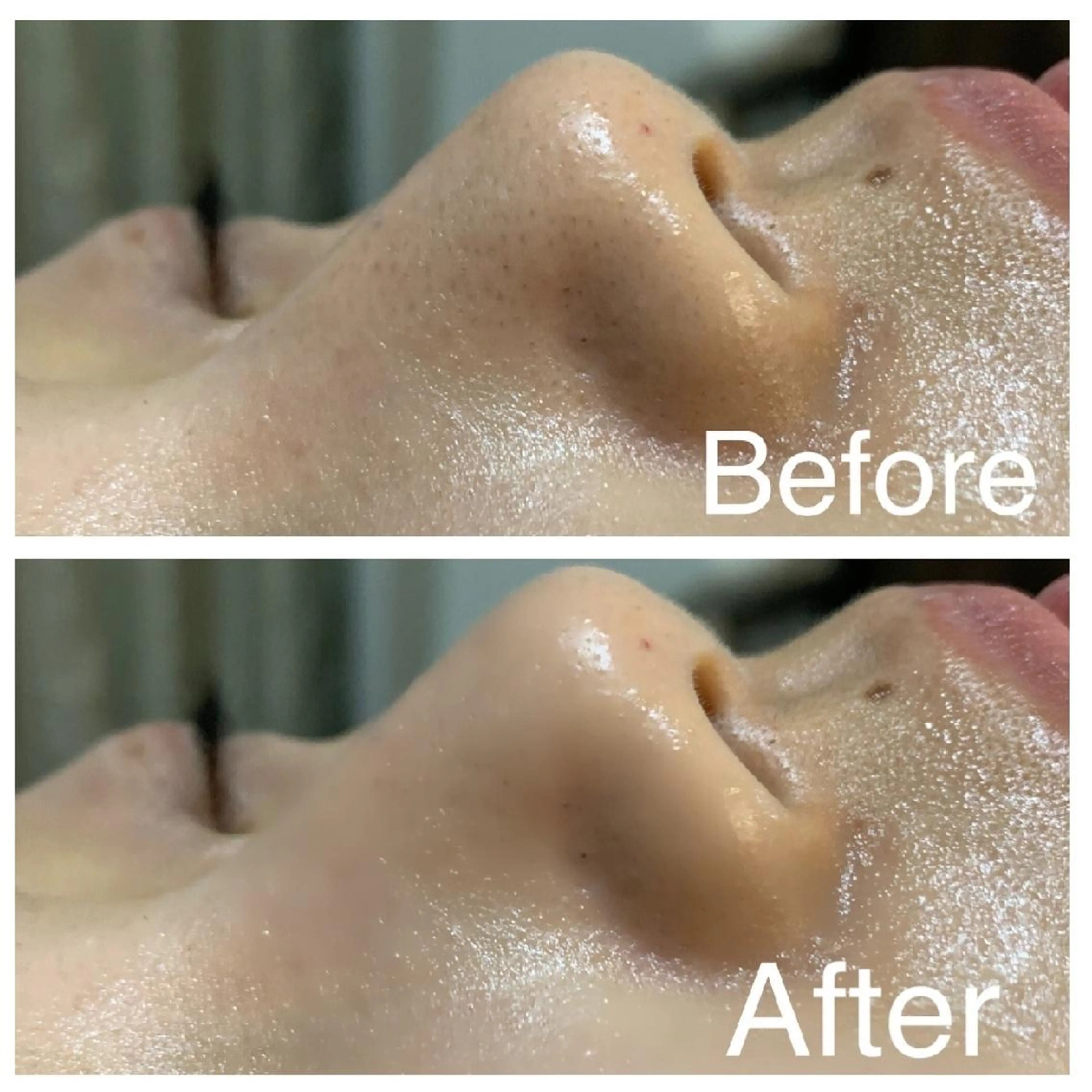 【憧れの美肌小顔✨】Vライン骨格小顔💎+つるつるタマゴ肌へ👸《毛穴/テカリ/ハリ/肌荒れ/乾燥》の写真