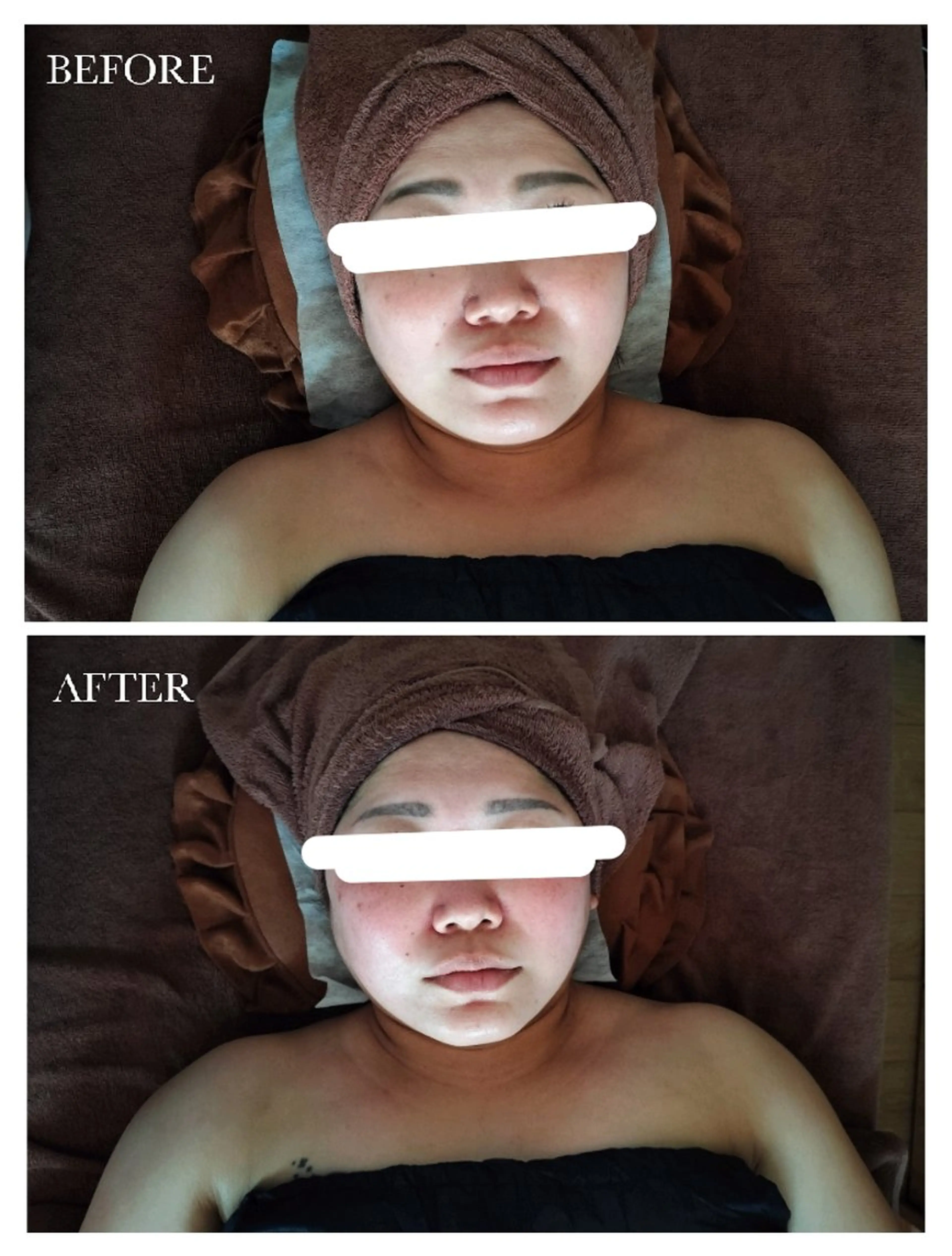 小顔矯正　60分の写真