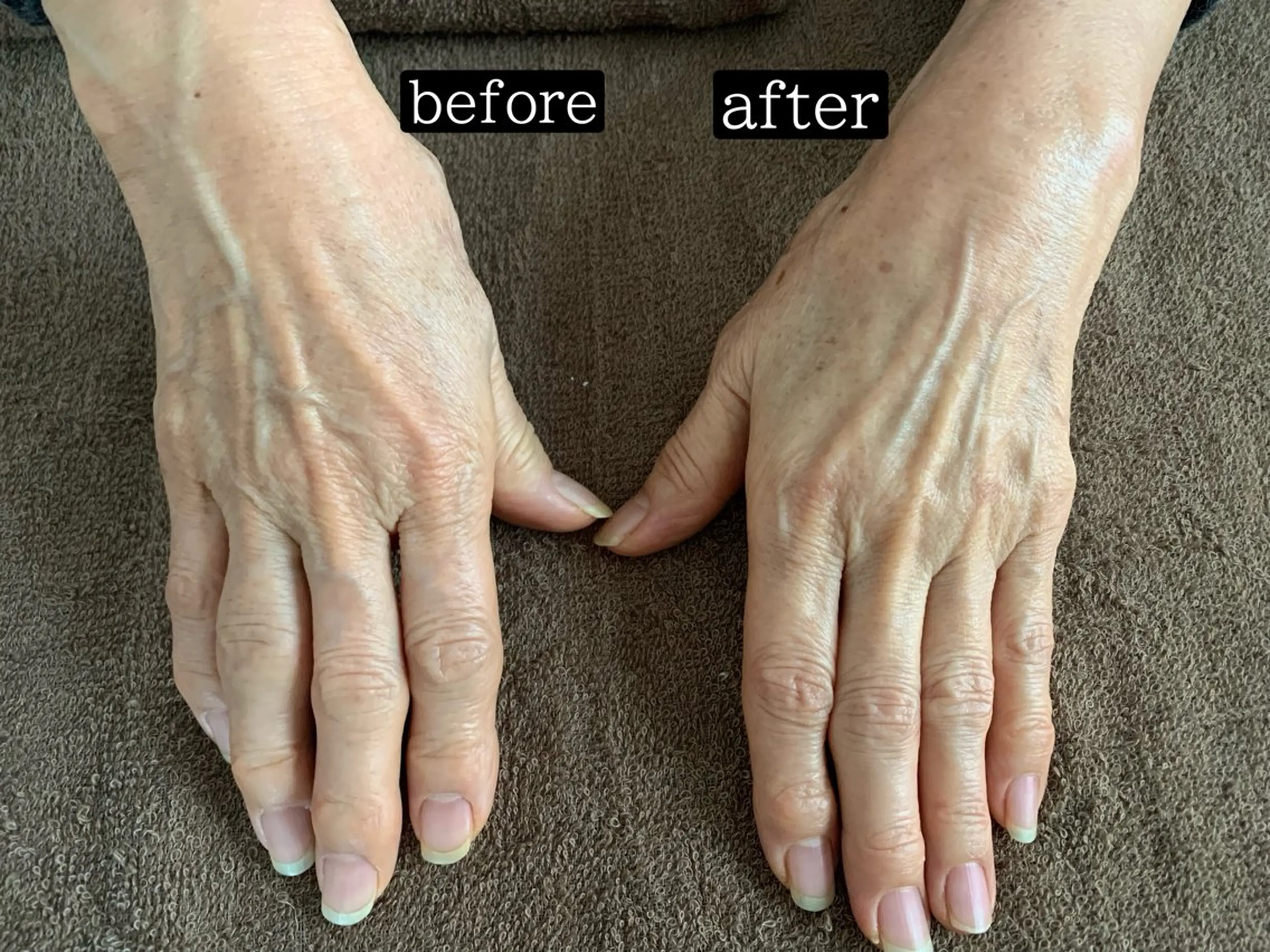 エイジングハンドケア（しみ、くすみ、ハリアップ）の写真