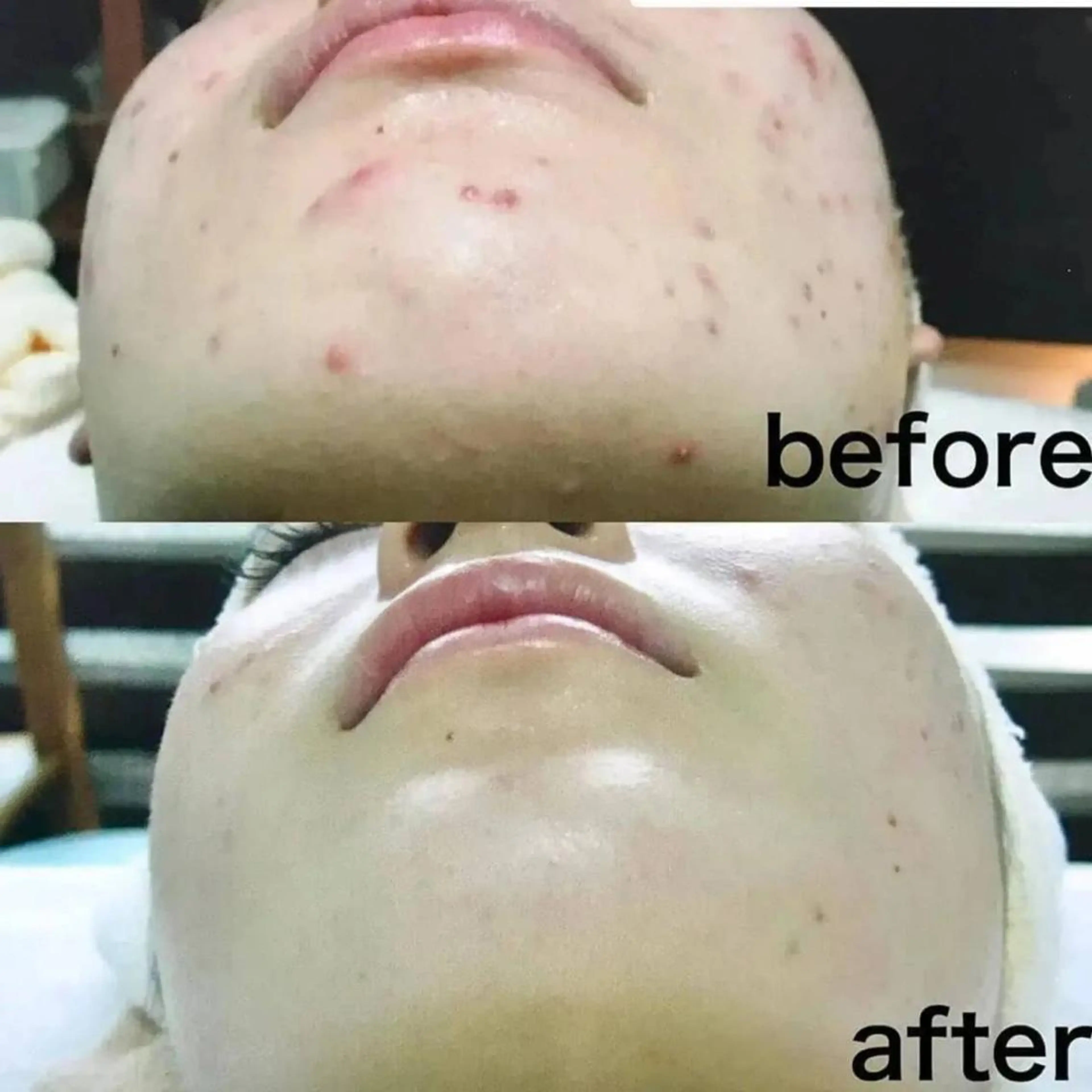 ニキビケア◇ニキビ跡 レゾン京橋店　八崎のエステ・リラクイメージ