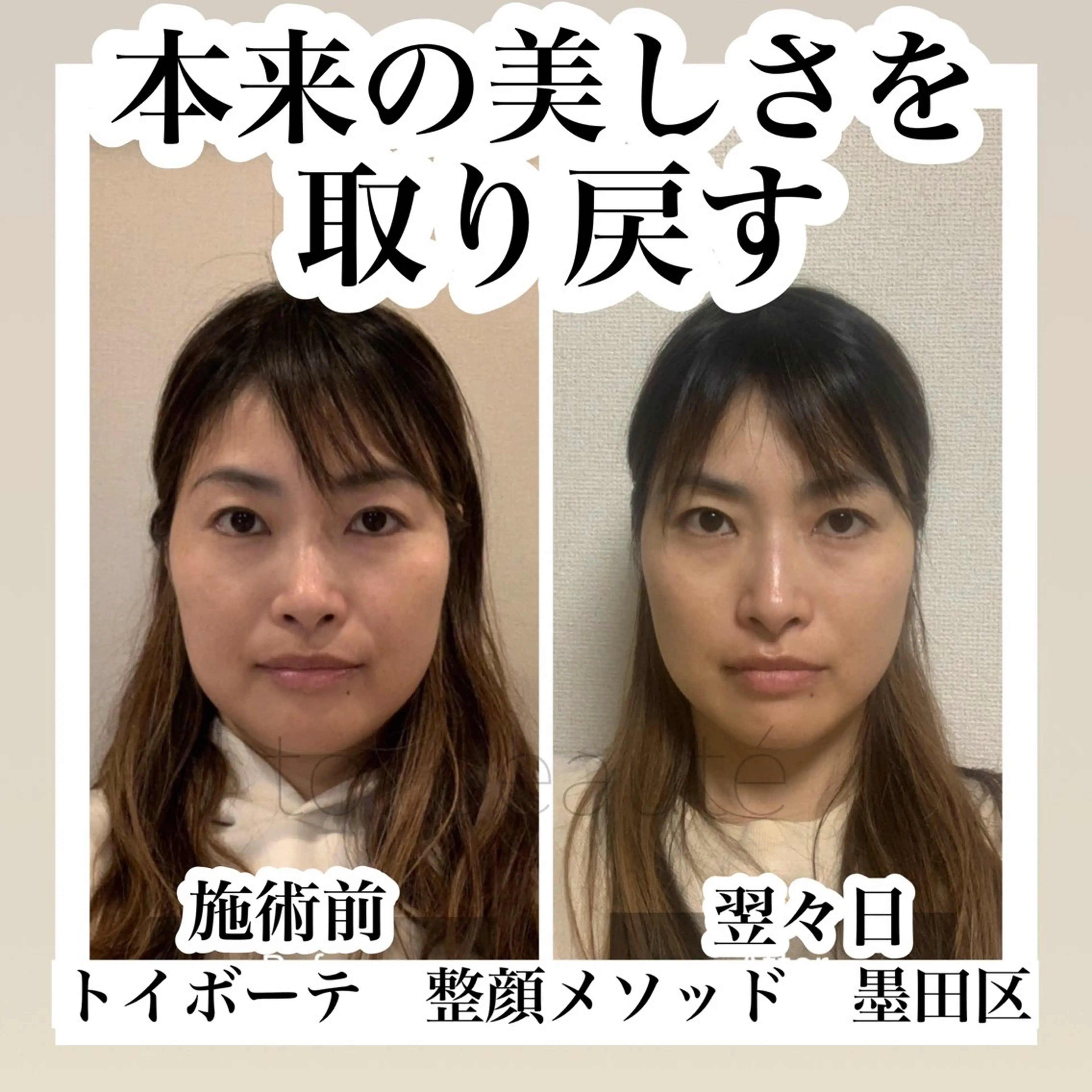 SNS顔出しOKの方🙆‍♀️40代​〜​50代限定！モニター募集中‼️痛くない小顔矯正💆‍♀️ほうれい線改善効果も⁉️の写真