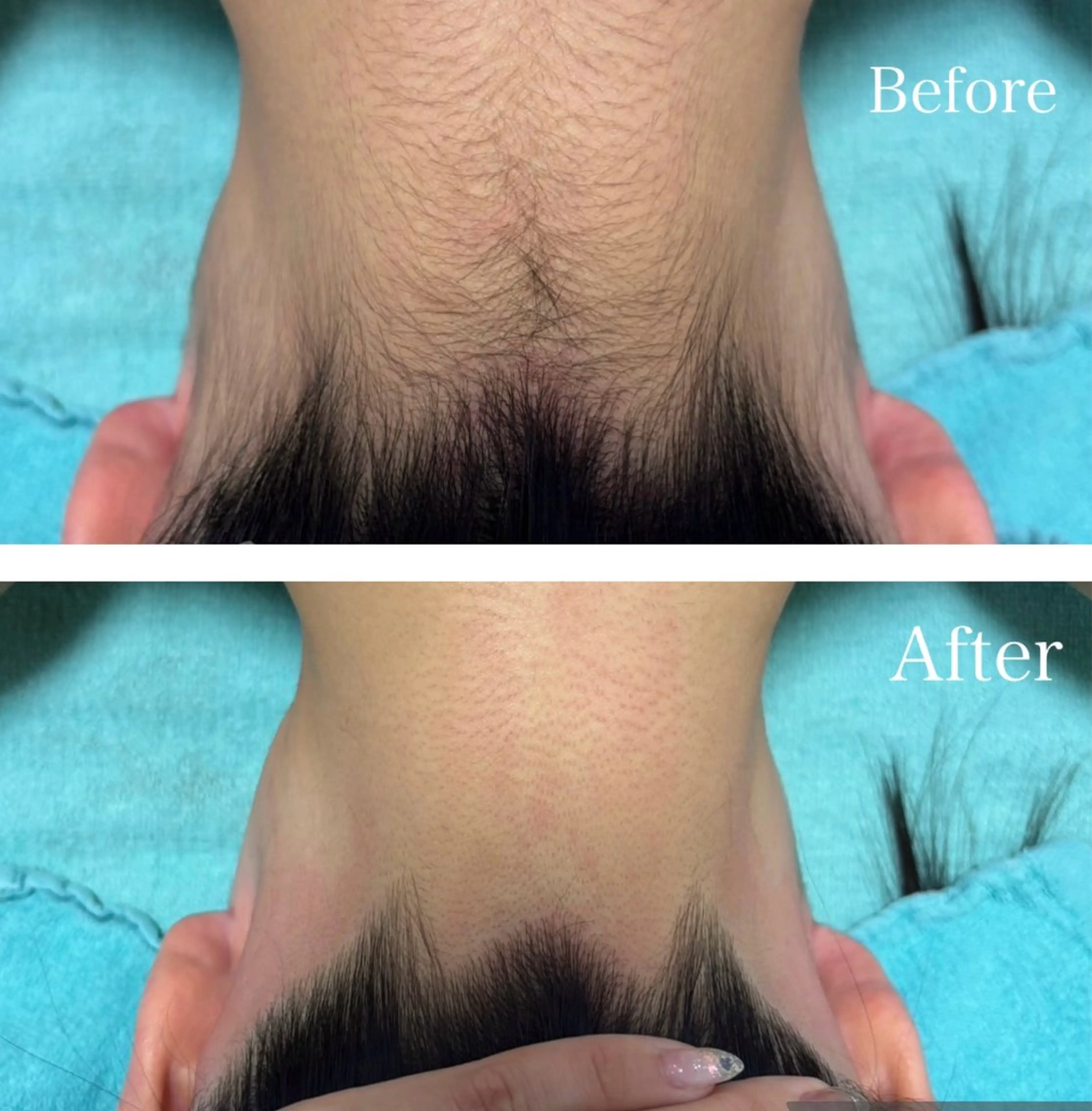 一般料金 ミニモ初回限定特別価格です🌟一般通常11000円（お友達紹介で1万円で通えます)VIO.顔含むの写真