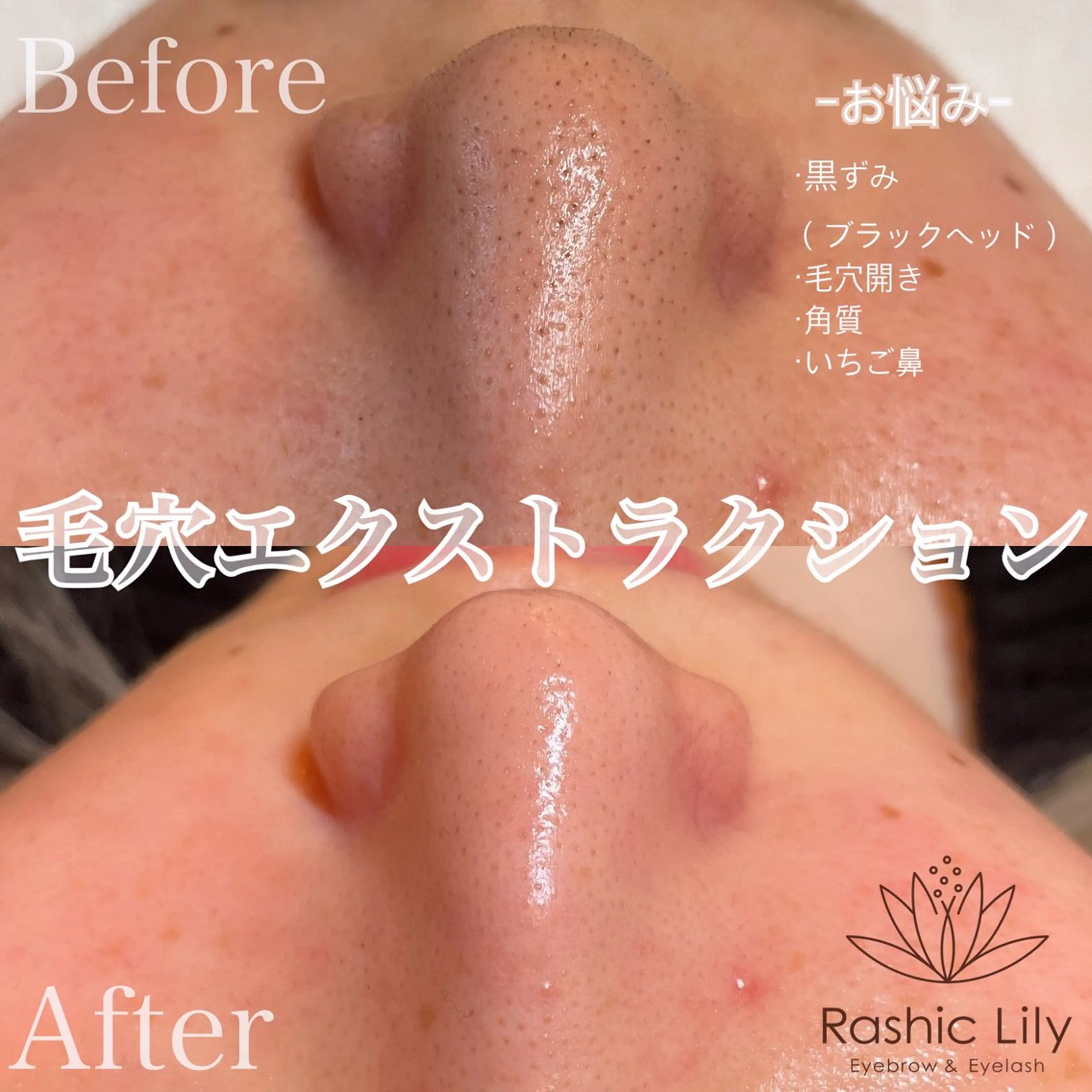 【ミニモ限定】ごっそり毛穴洗浄🍓!!毛穴エクストラクション🌿美鼻ベーシックコースの写真