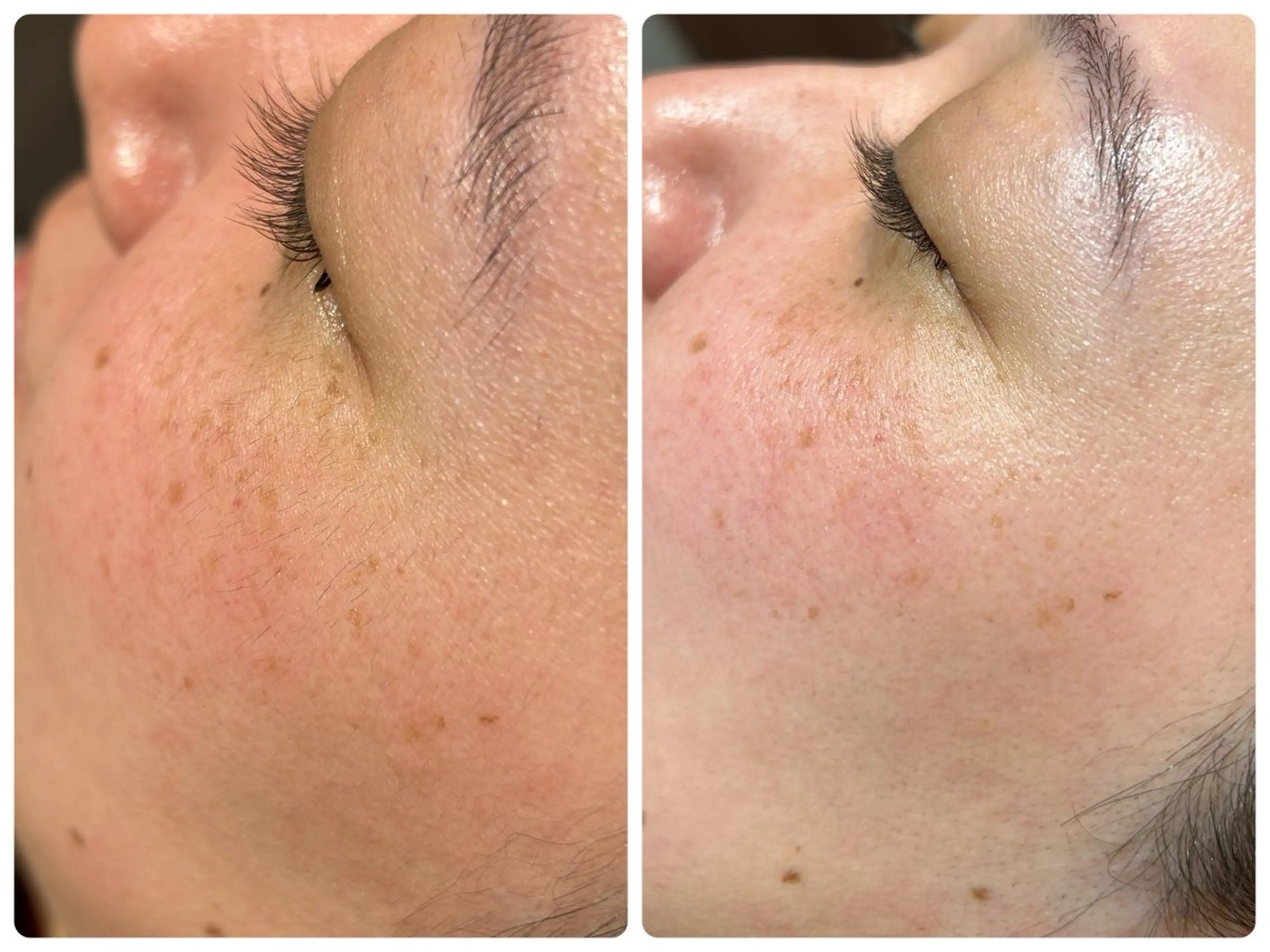 【角質・産毛除去で滑らかな肌へ】フェイシャルシェービングの写真