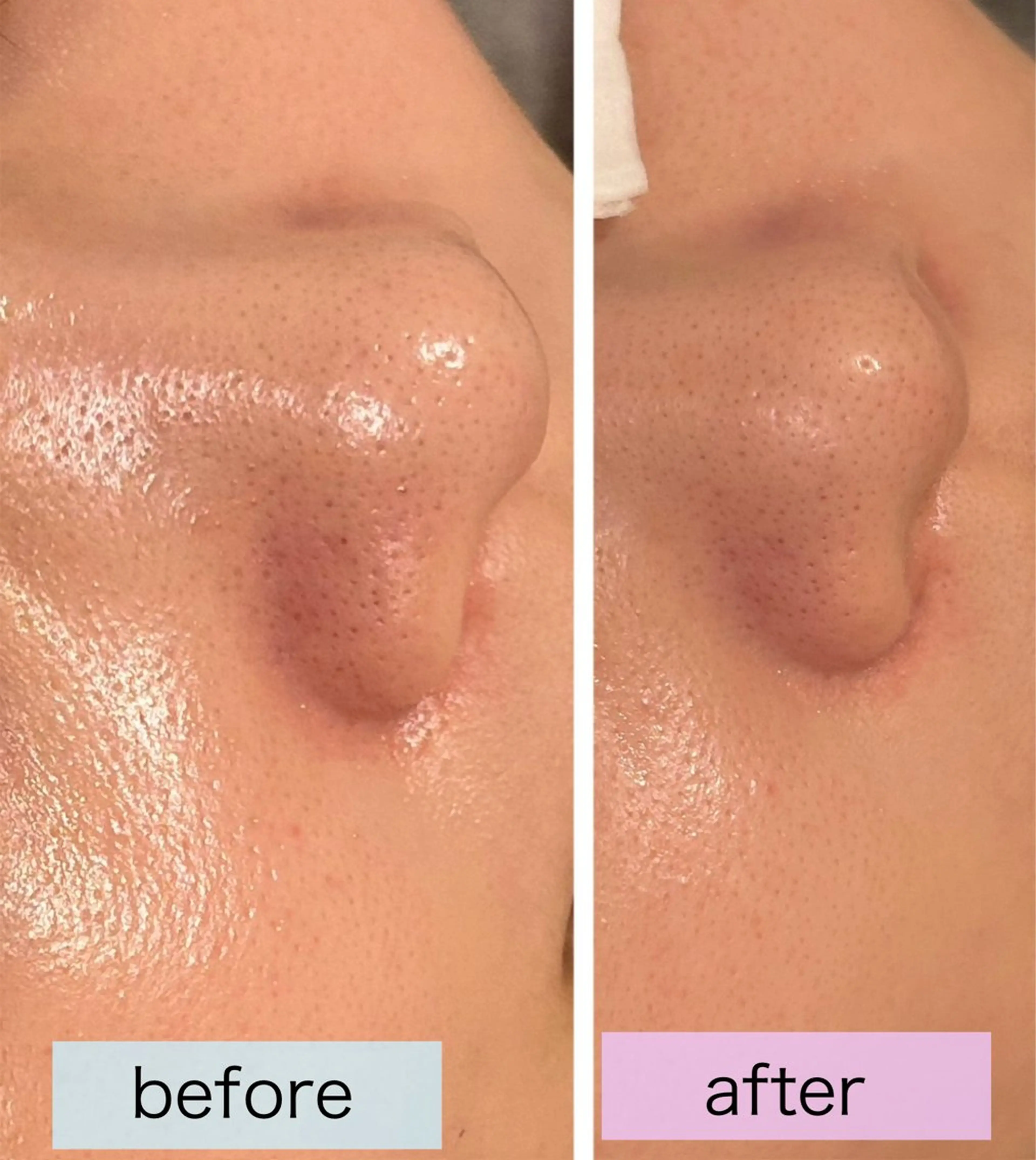 ✨毛穴キュ！光フェイシャルで美肌✨¥8,900→¥3500の写真