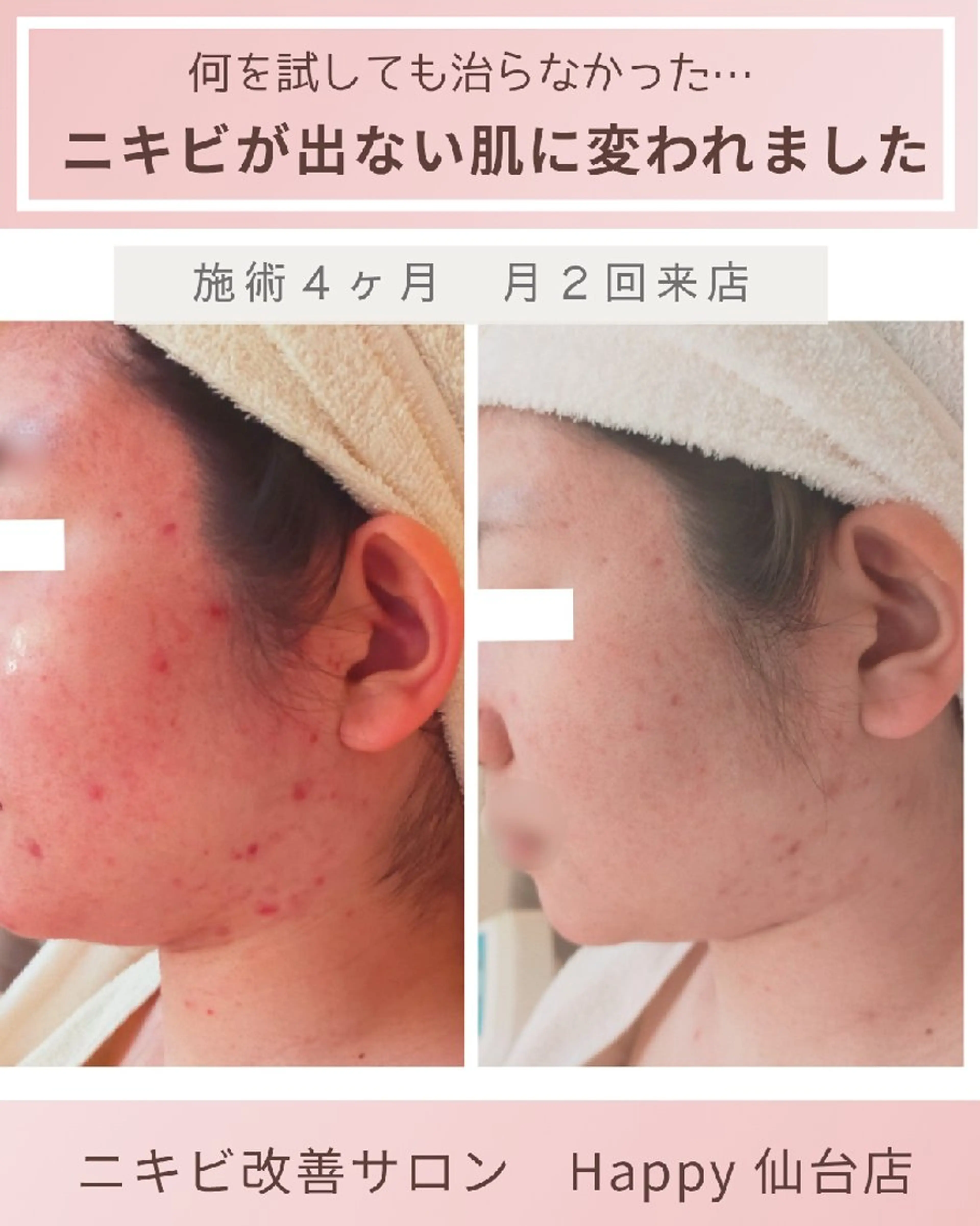 ニキビ肌ケアサロン Happy所属・ニキビ肌ケアサロン  Happy のエステ・リラクイメージ