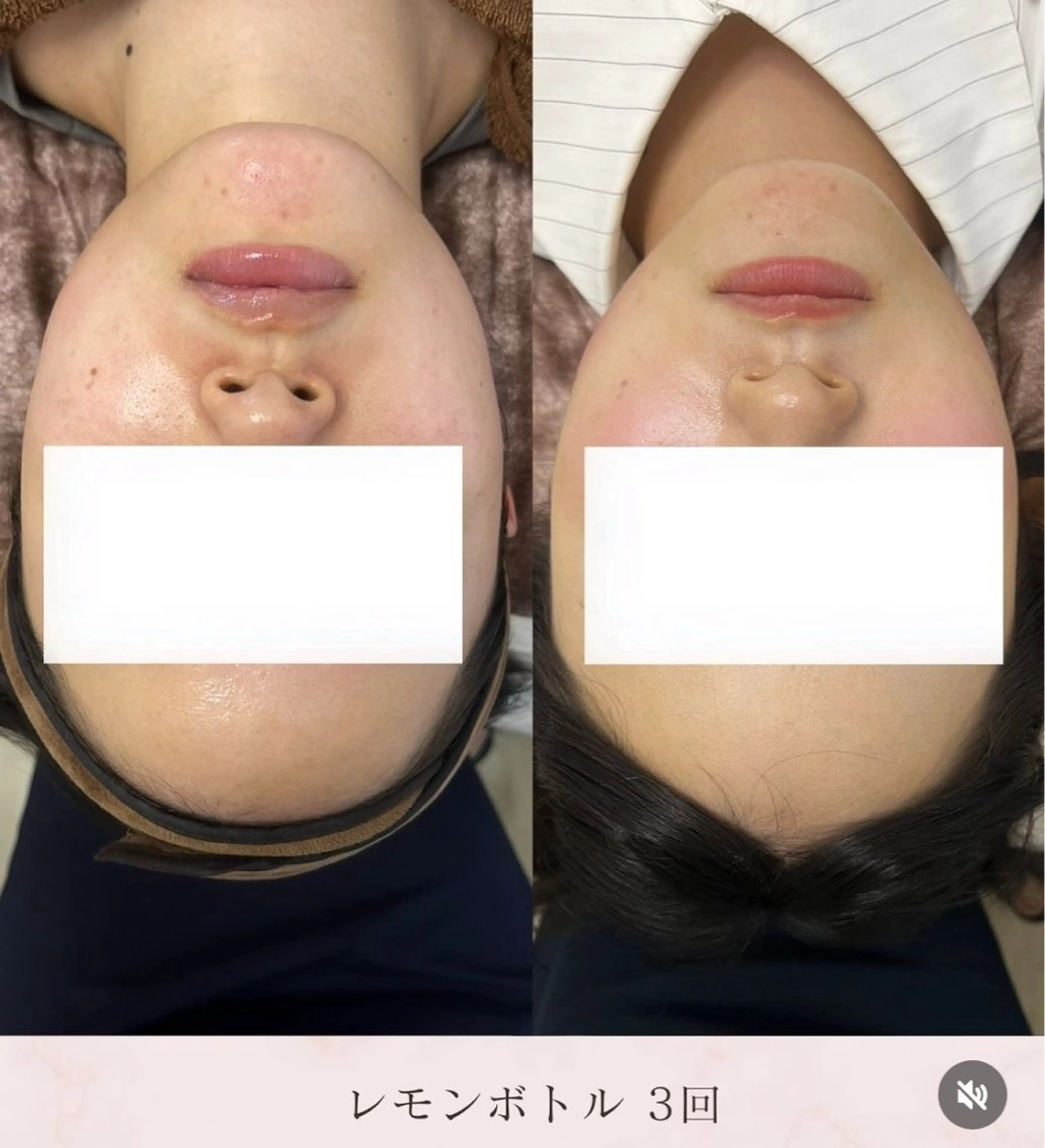 美肌毛穴ケア/看護師 🌷ナスサロmanaのエステ・リラクイメージ