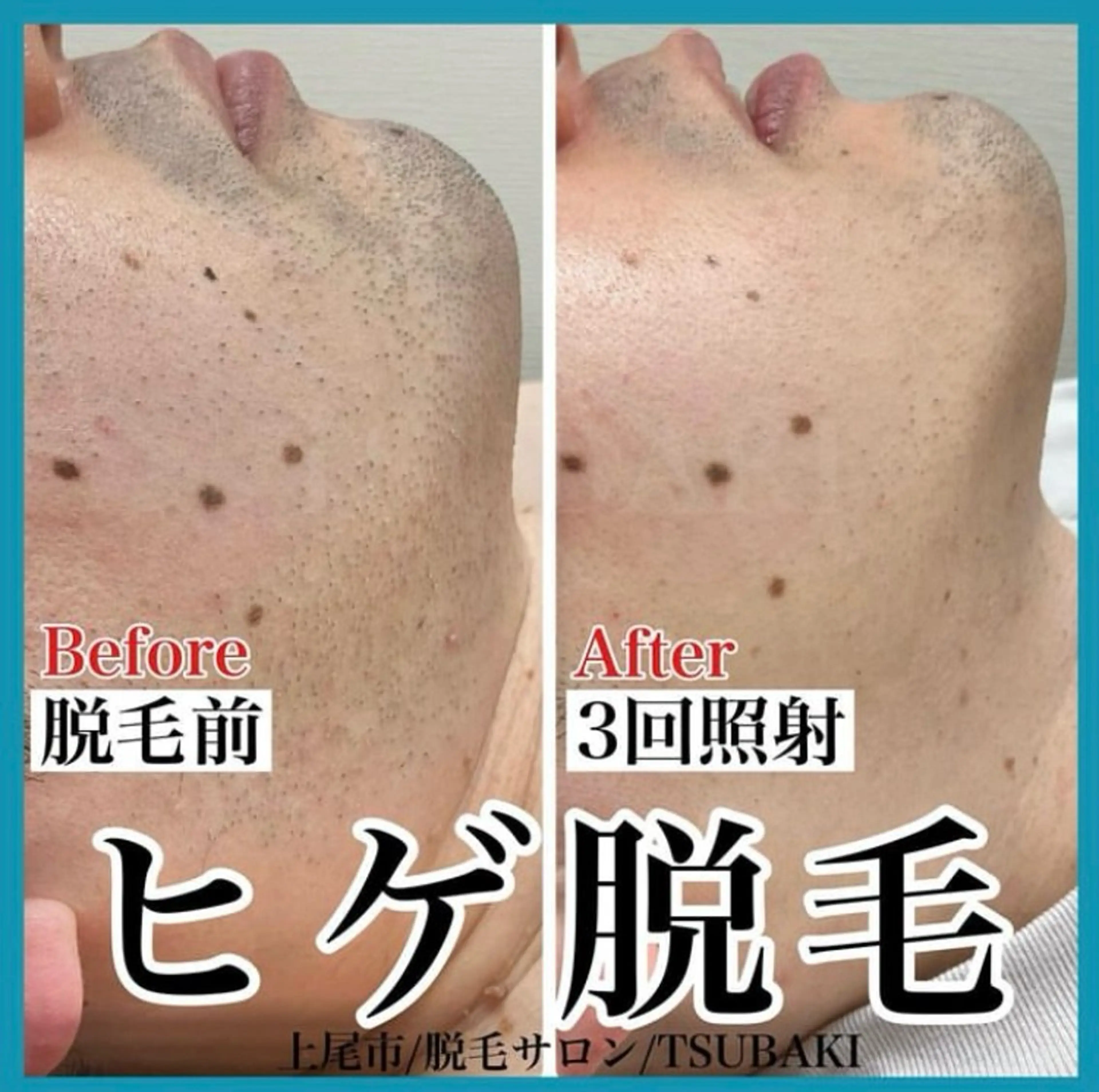 メンズ 脱毛 TSUBAKI上尾店所属・TSUBAKI上尾店 松下のエステ・リラクイメージ