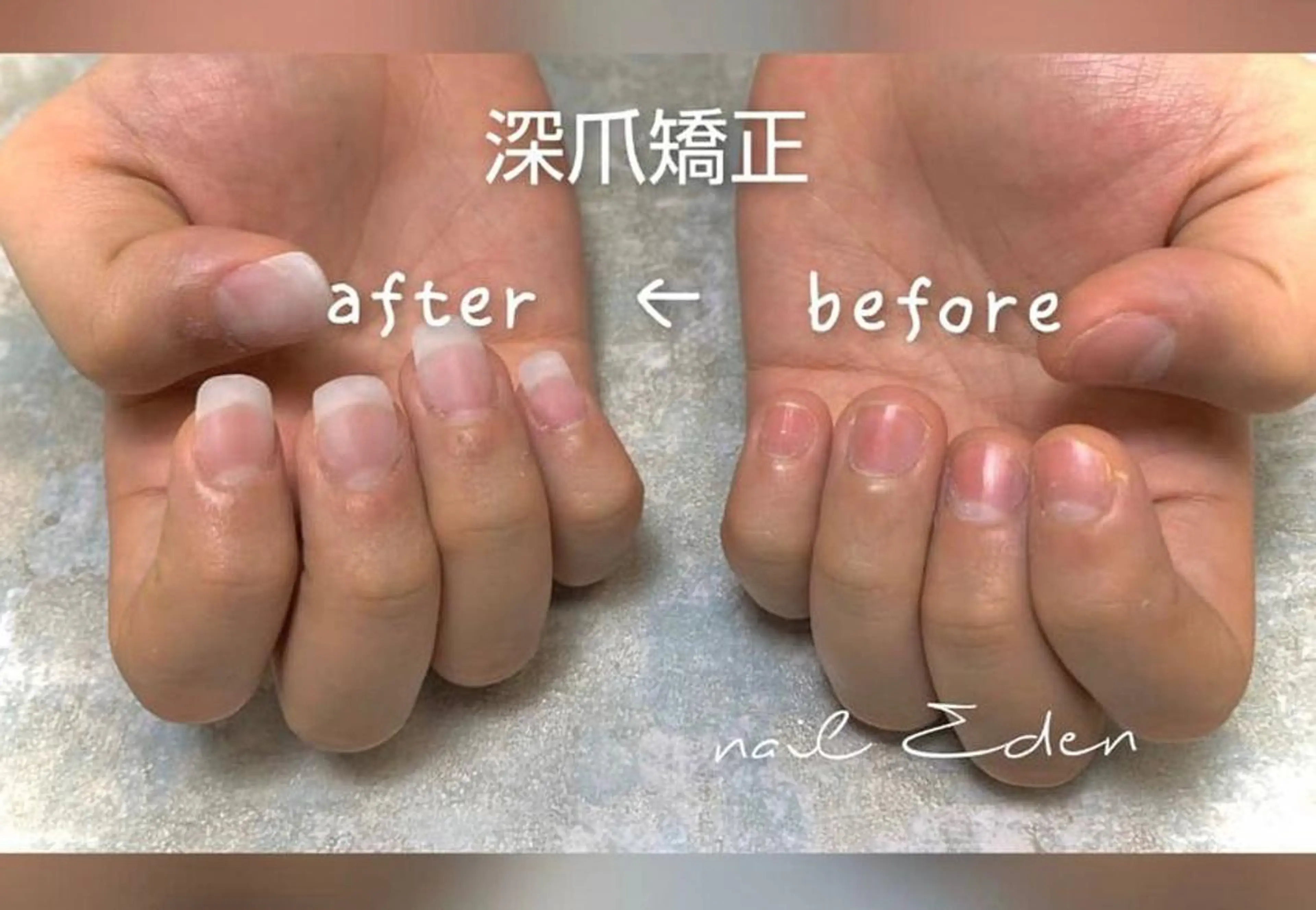 ネイル アートネイル クリアネイル 長さ出し フットネイル フレンチネイル Eden ♾️のネイルデザイン