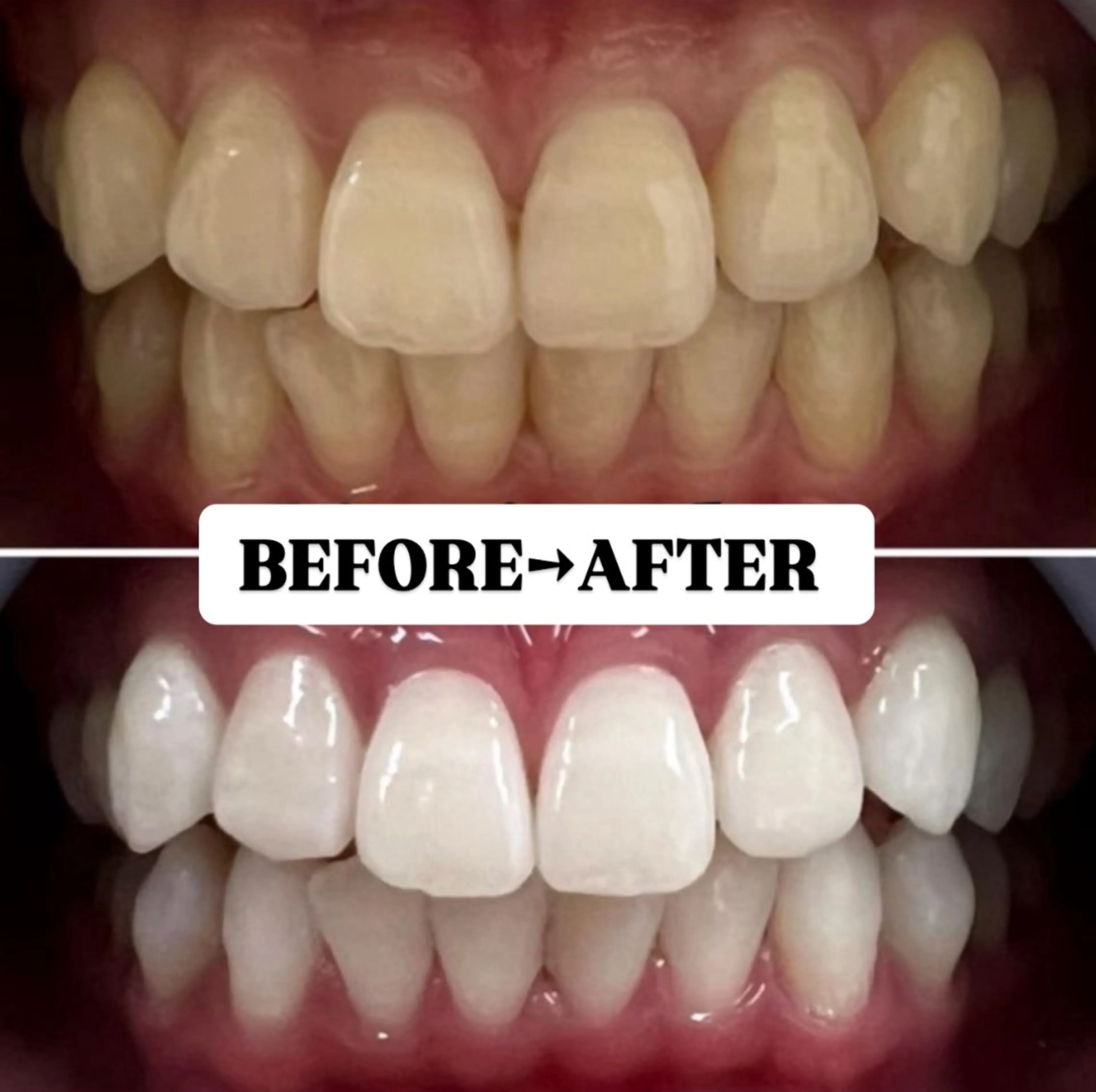 【お得な5回コース】美白ホワイトニング20分×10回 ¥25,000の写真