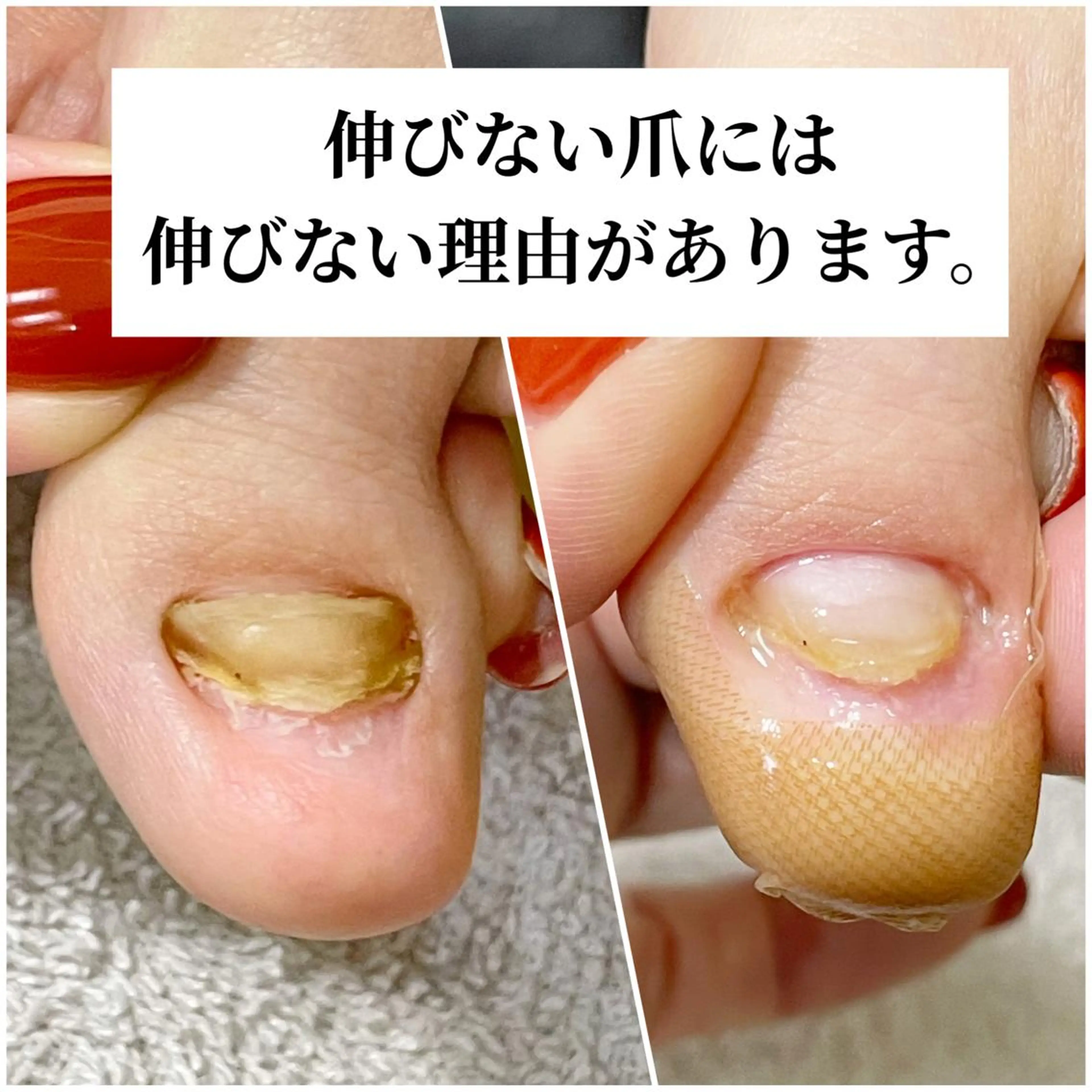 ネイル 深爪・巻き爪 専門サンセリテのネイルデザイン