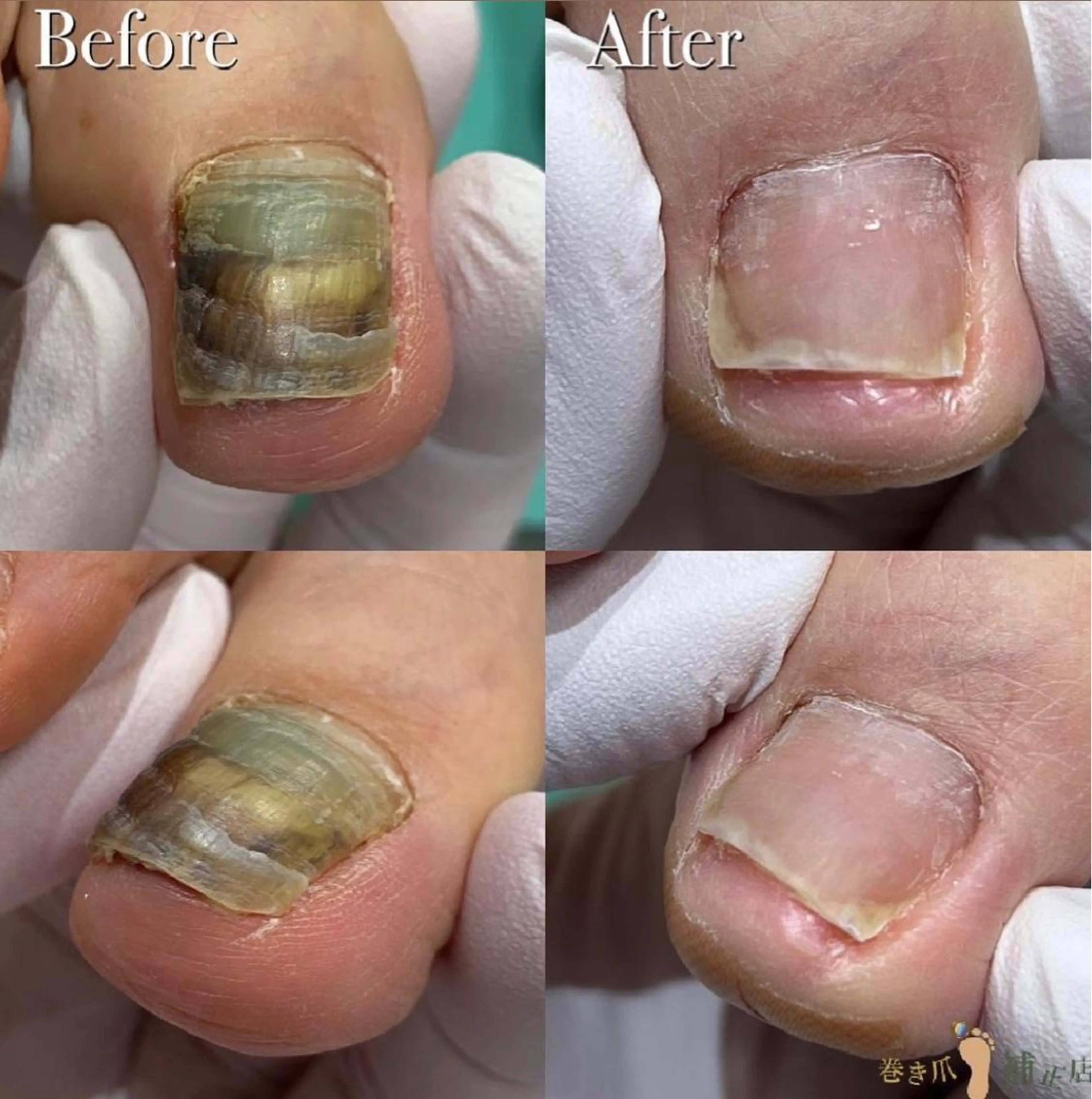 【足の分厚い爪・深爪再生補正】思わず隠したくなるその爪…😢諦めないでください🌈正常な爪へ再生致します💁‍♀️の写真