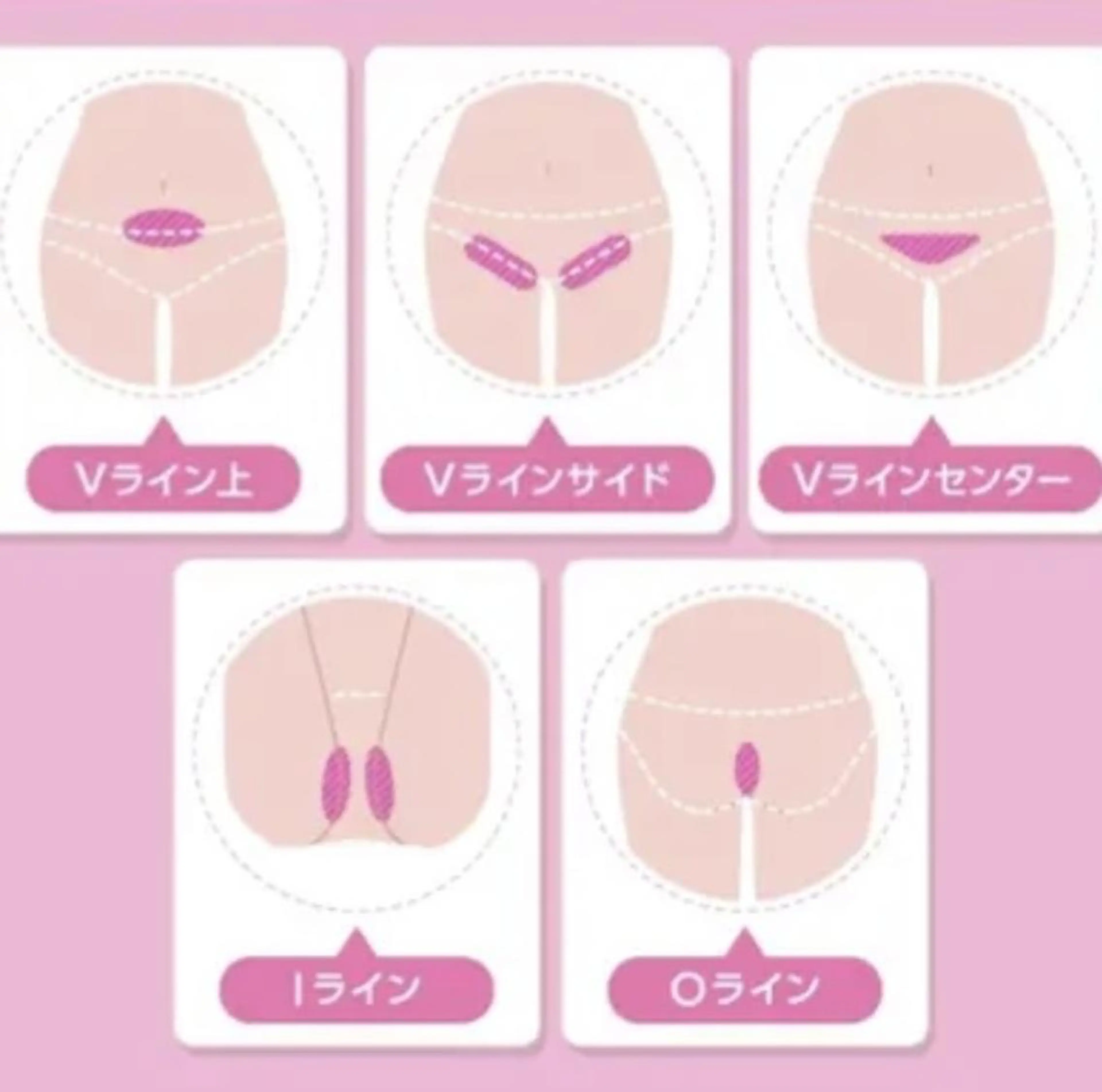 ⛄️VIO美肌脱毛⛄️冷却機能・デザイン自由👌本気で毛をなくしたい方必見💍目指せ自己処理いらず肌🌟の写真