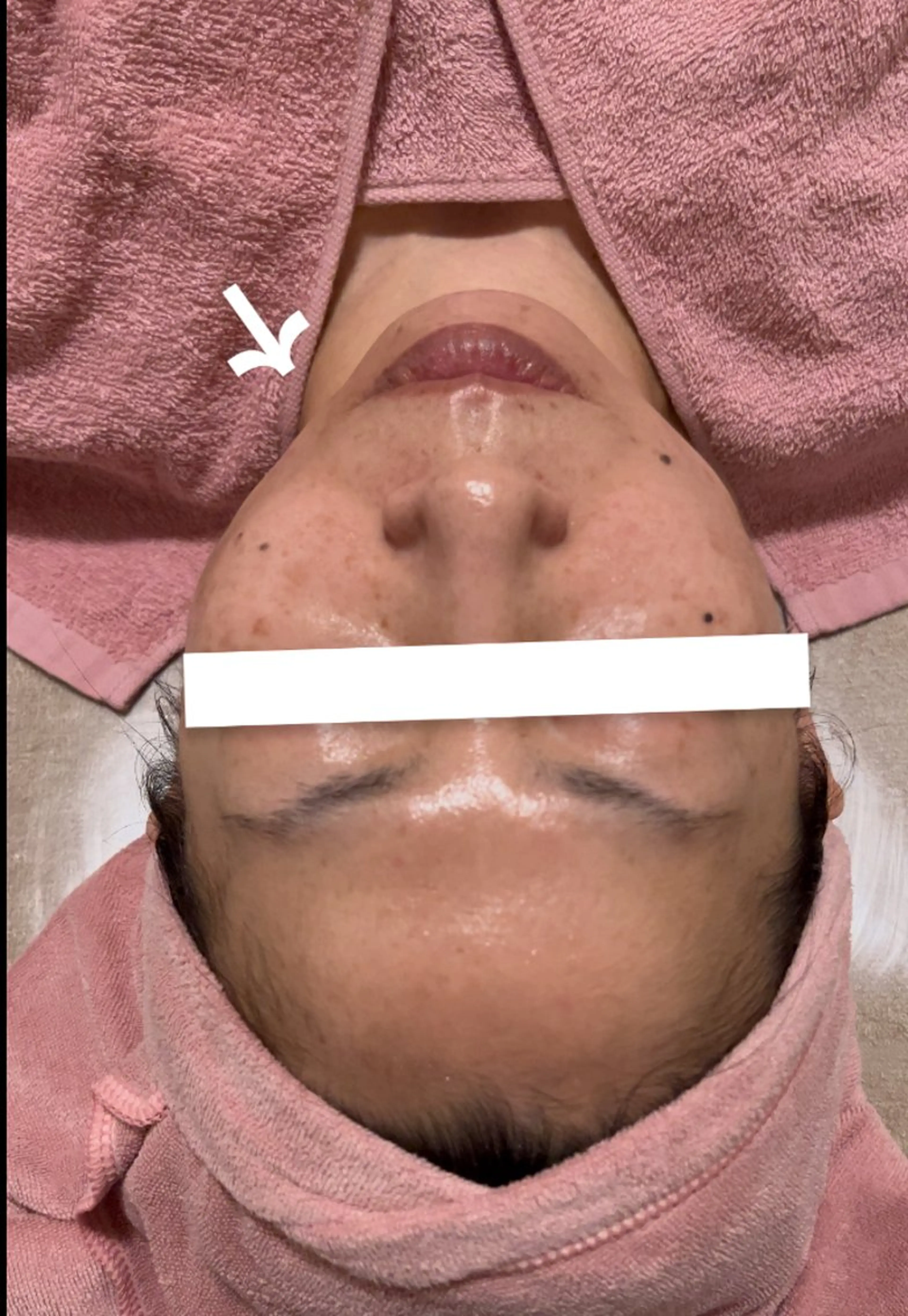 【脱丸顔・二重アゴ】注射器のいらない脂肪除去 痛みなし・ダウンタイムなし!当日からメイク可!の写真