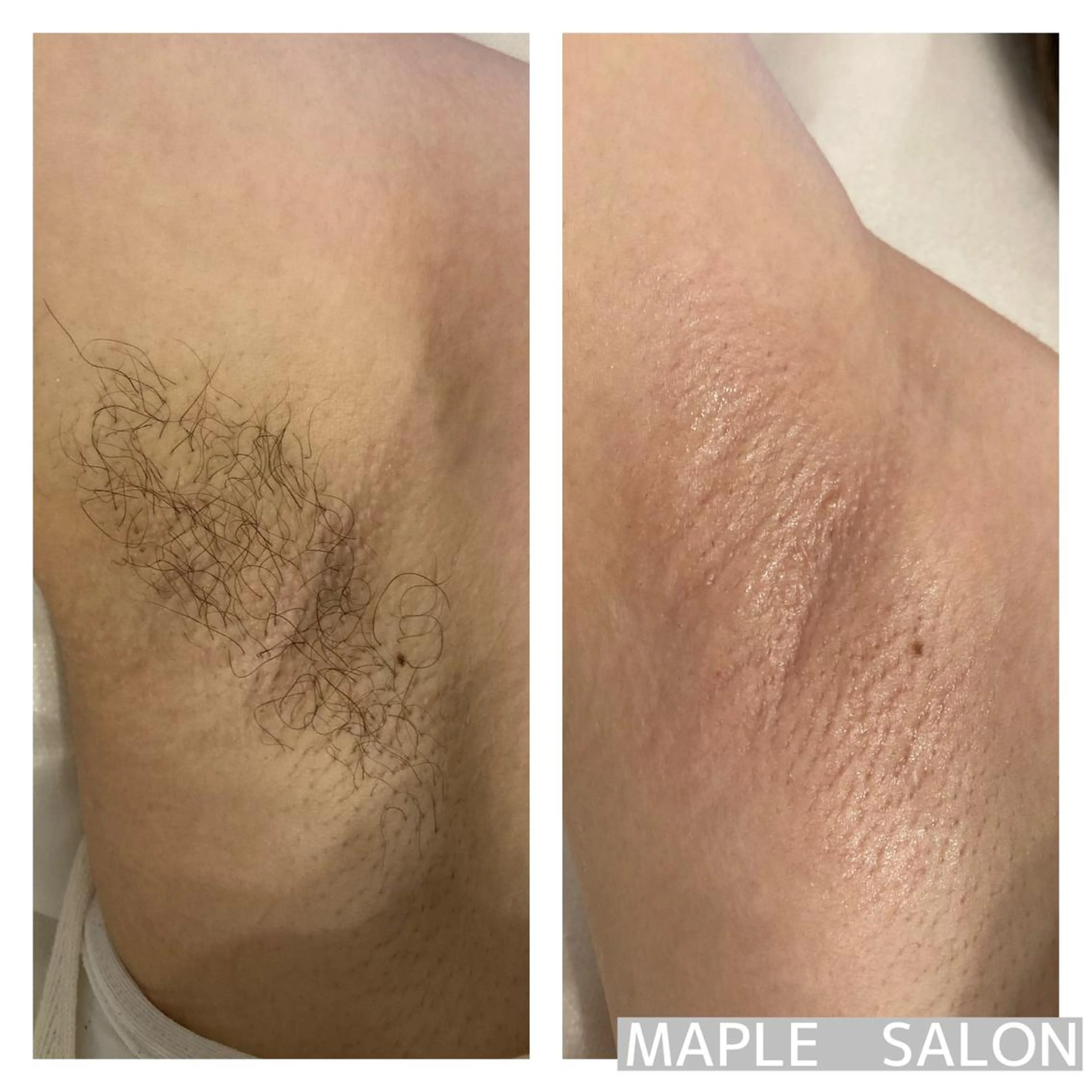 脱毛 MARI シュガーリストのエステ・リラクイメージ