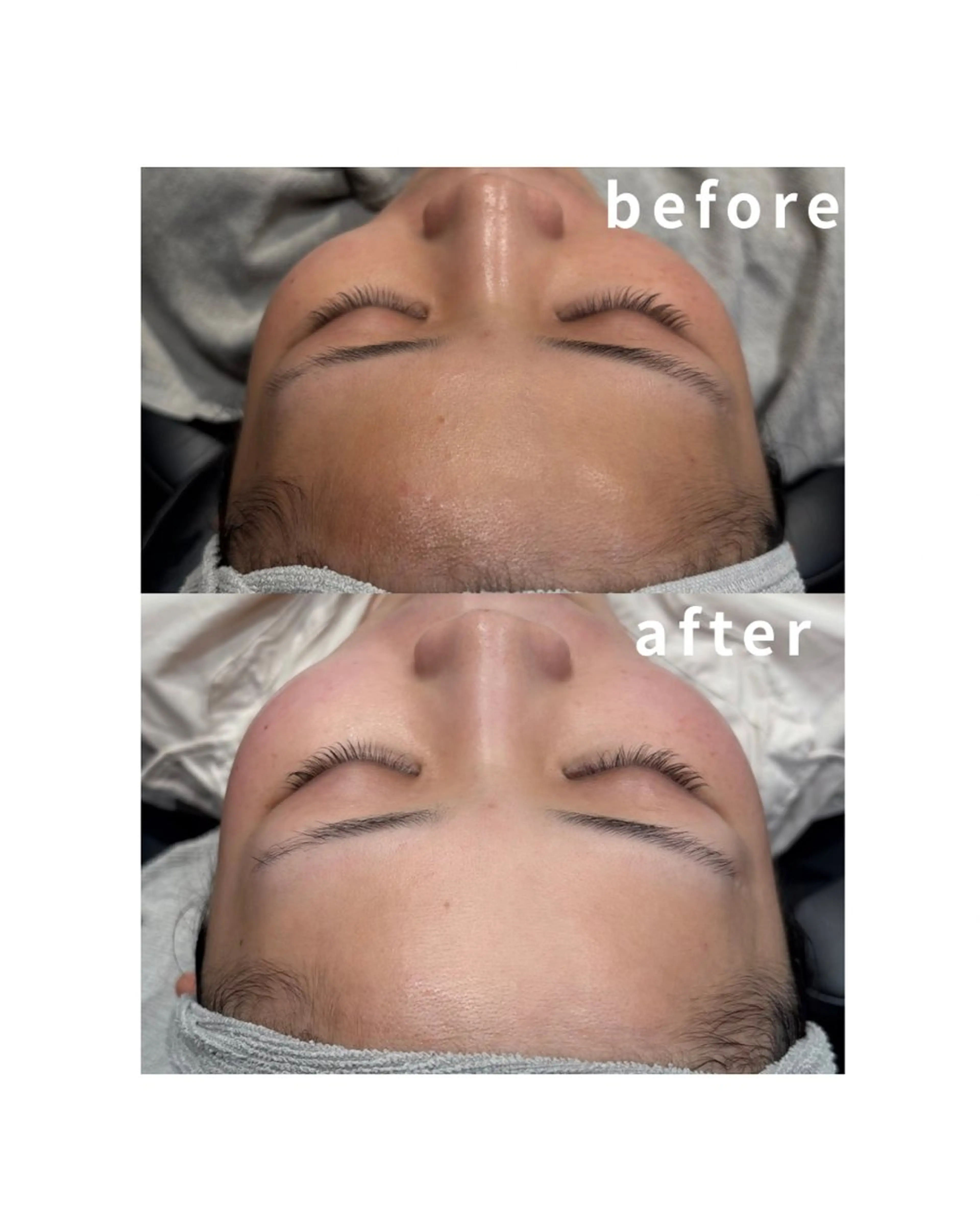 【プレミアムシェービング】クレンジング＋顔シェービング（眉込み）＋リフトアップマッサージ＋酵素パック＋ACパックの写真