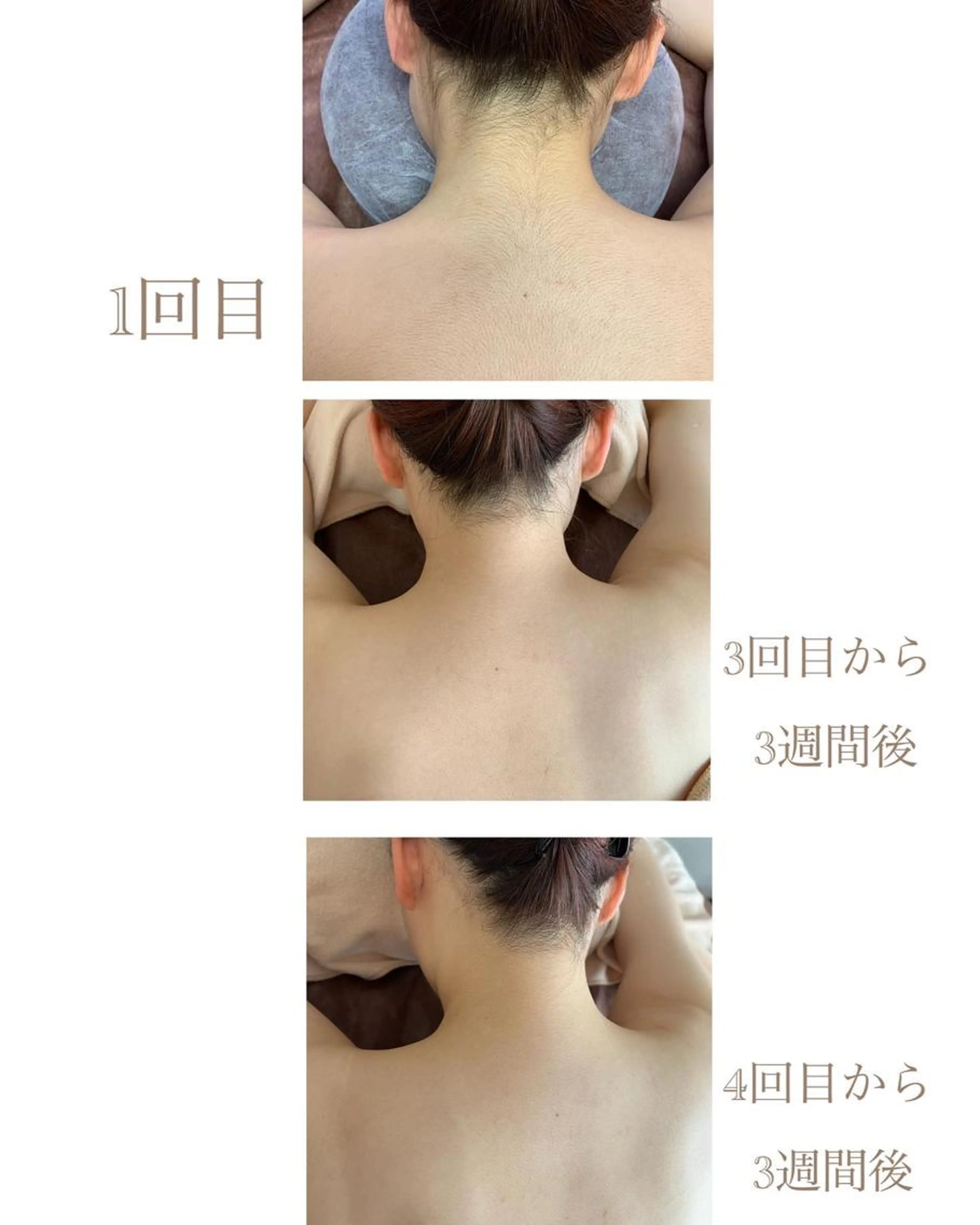 ✨うなじ・肩・背中上まで脱毛✨1回都度払い💎見せれる綺麗な後姿に💎の写真