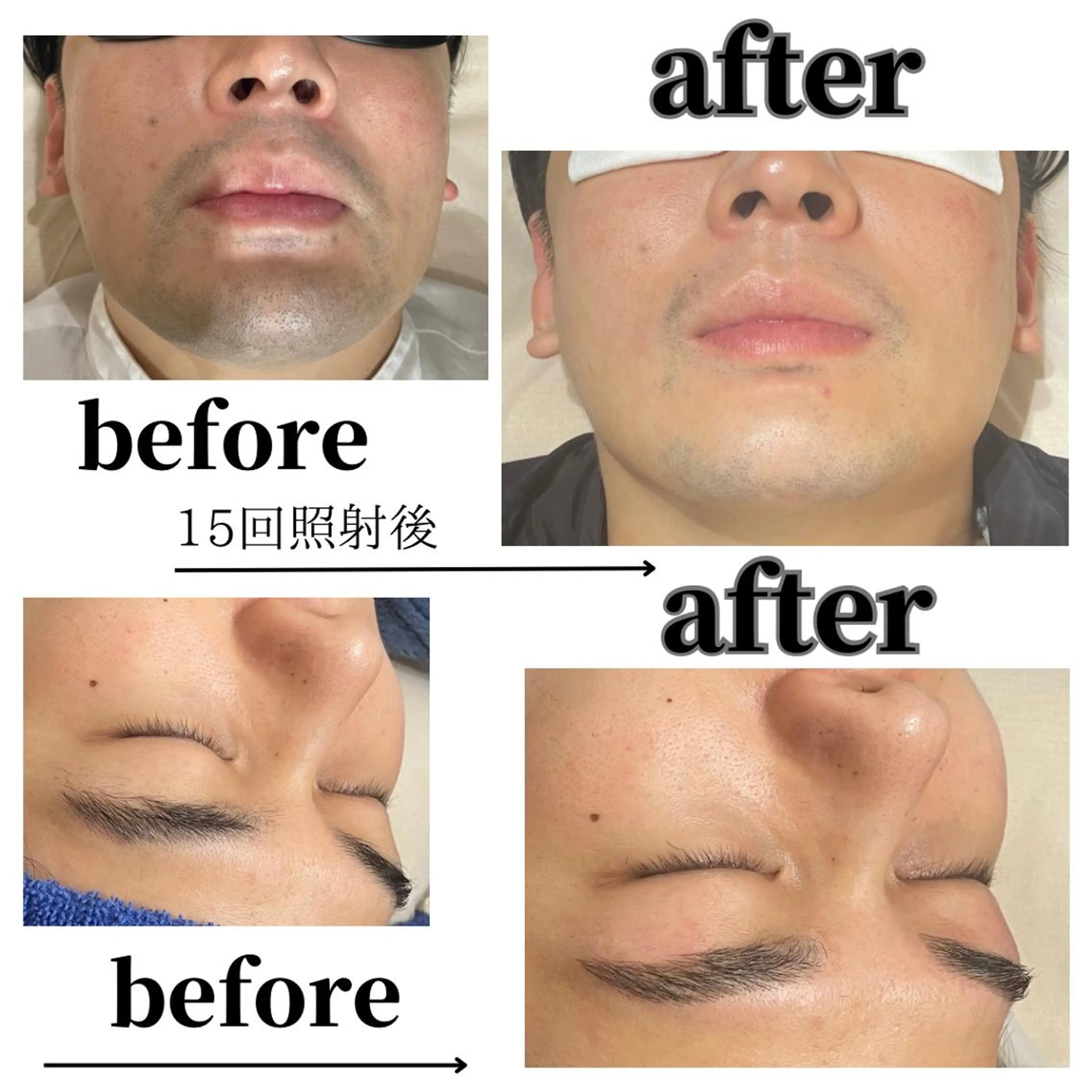 ●ミニモ限定【全顔メンズ脱毛＋眉ワックス脱毛】◎¥4700の写真