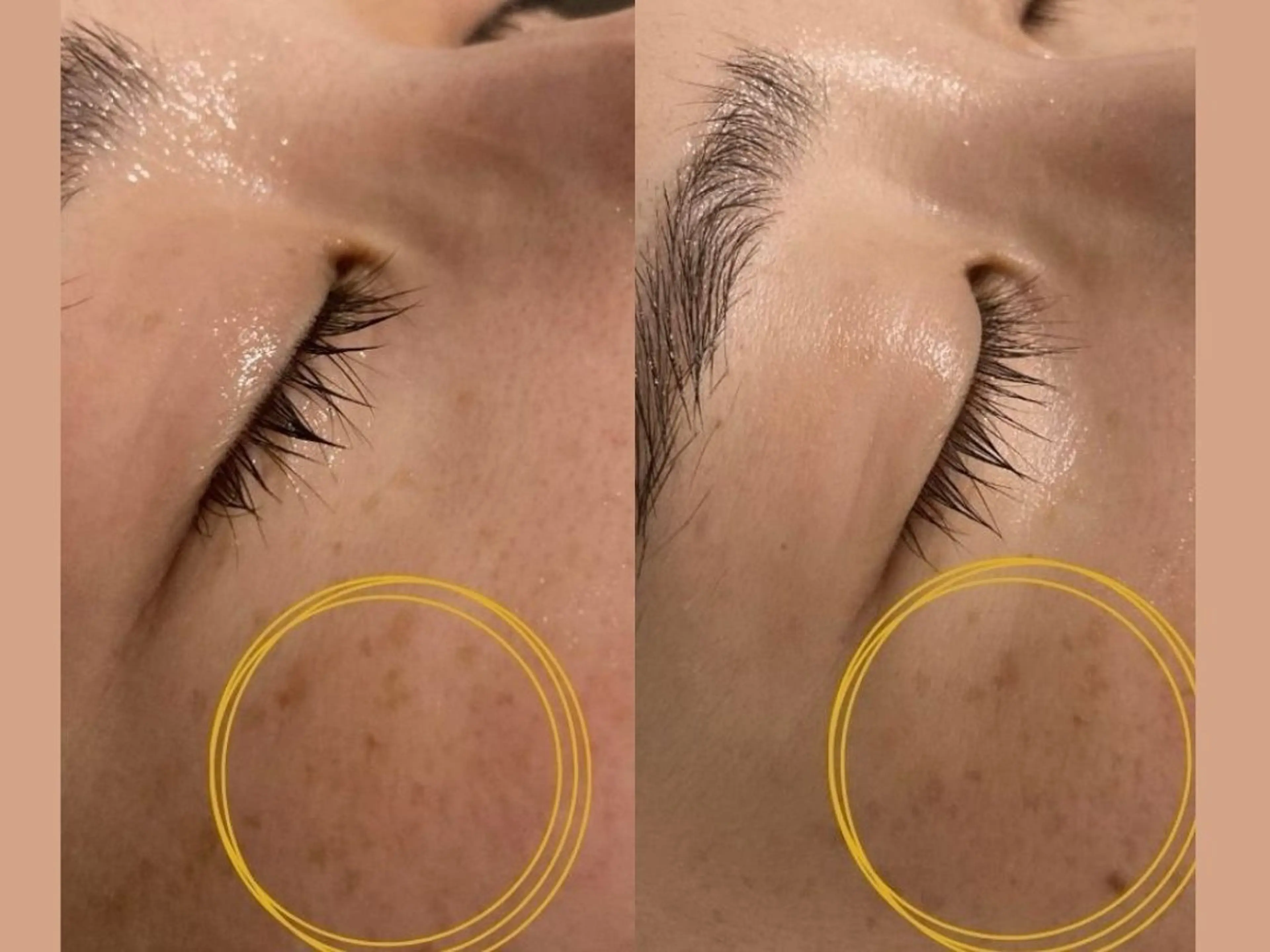 【肌質改善/活性化】均一美肌の土台育てる万能光フォトコースの写真