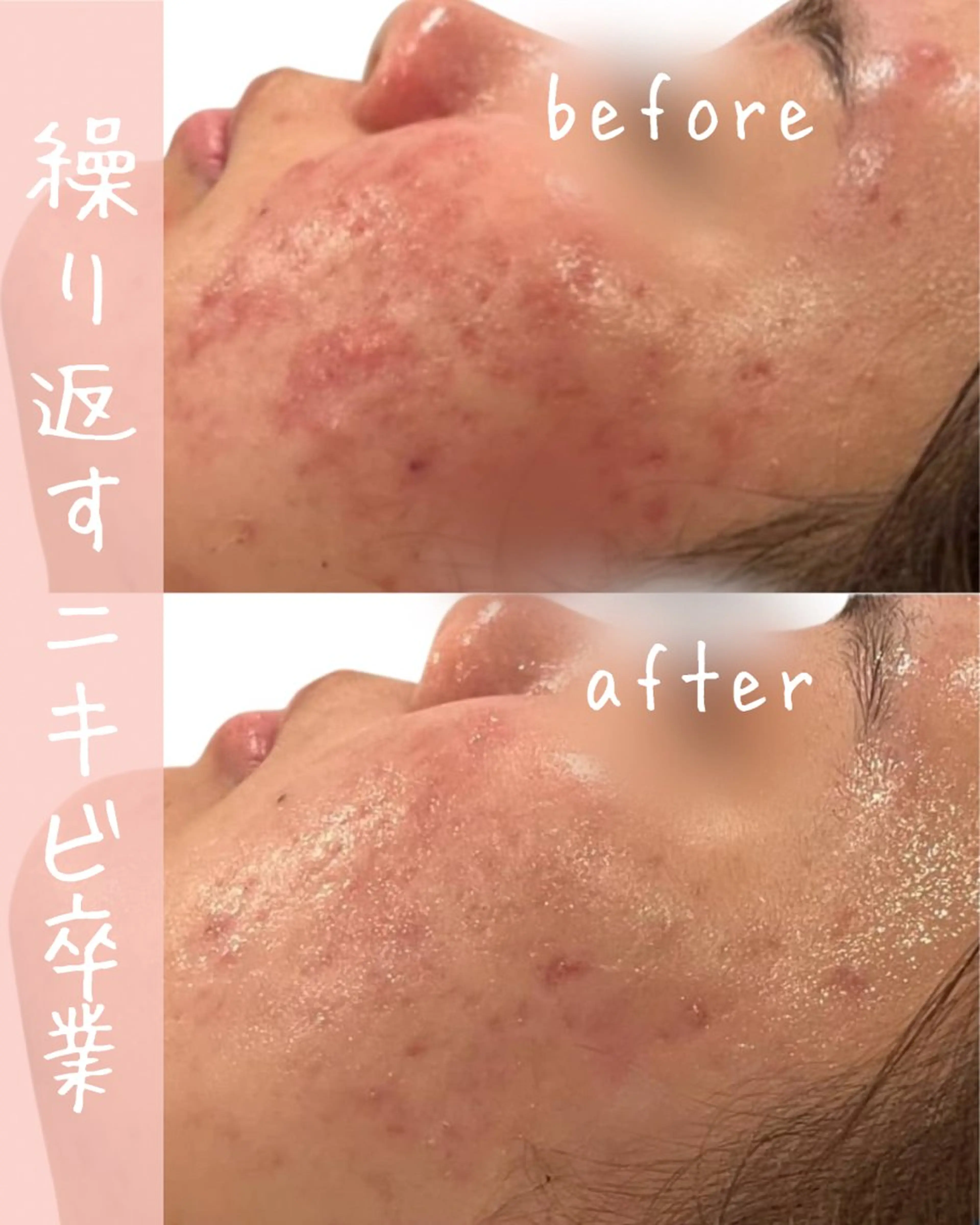 エステ ｍｉkｉ 東根の肌質改善サロンのエステ・リラクイメージ