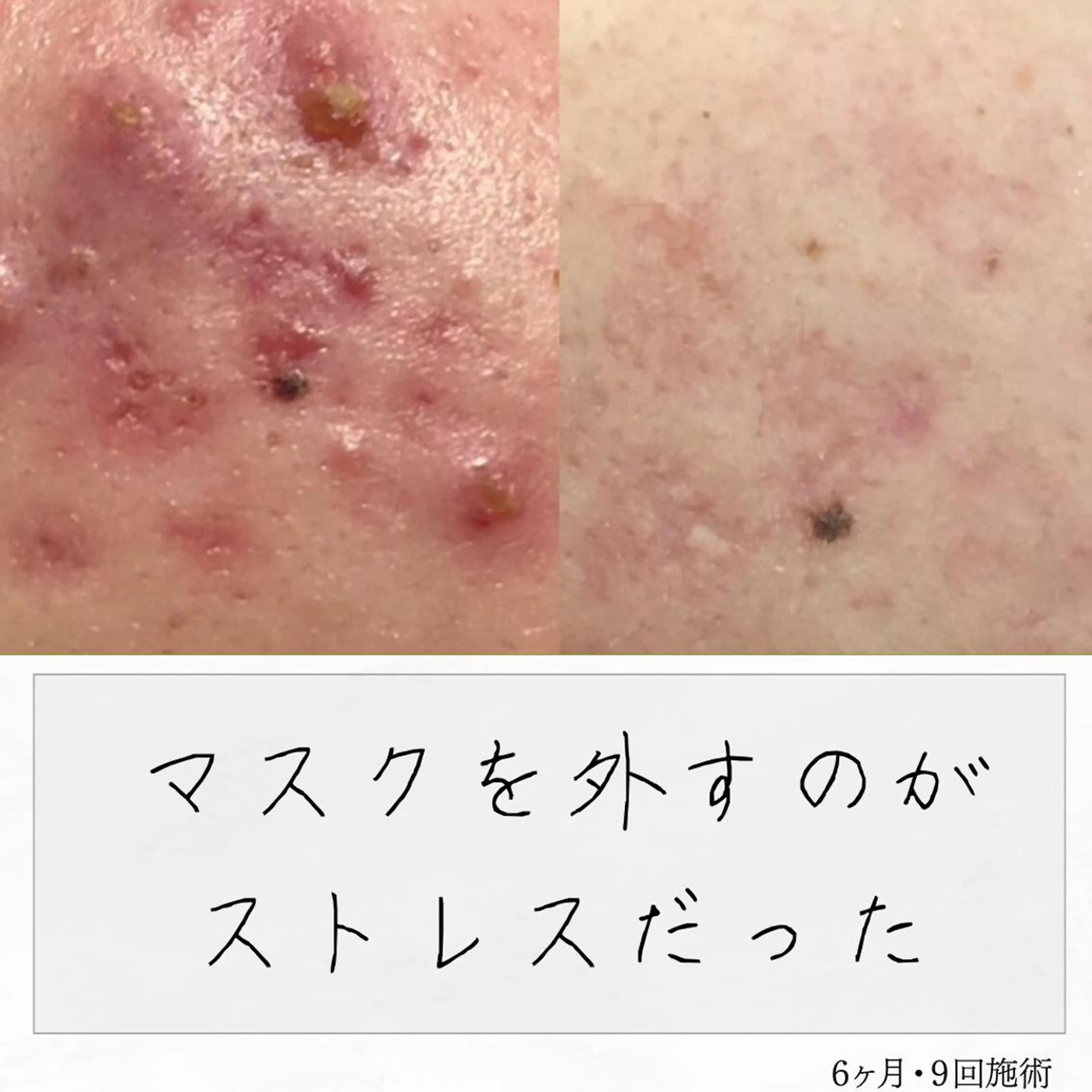 ニキビ経験者が施術 する専門サロン🌻のエステ・リラクイメージ