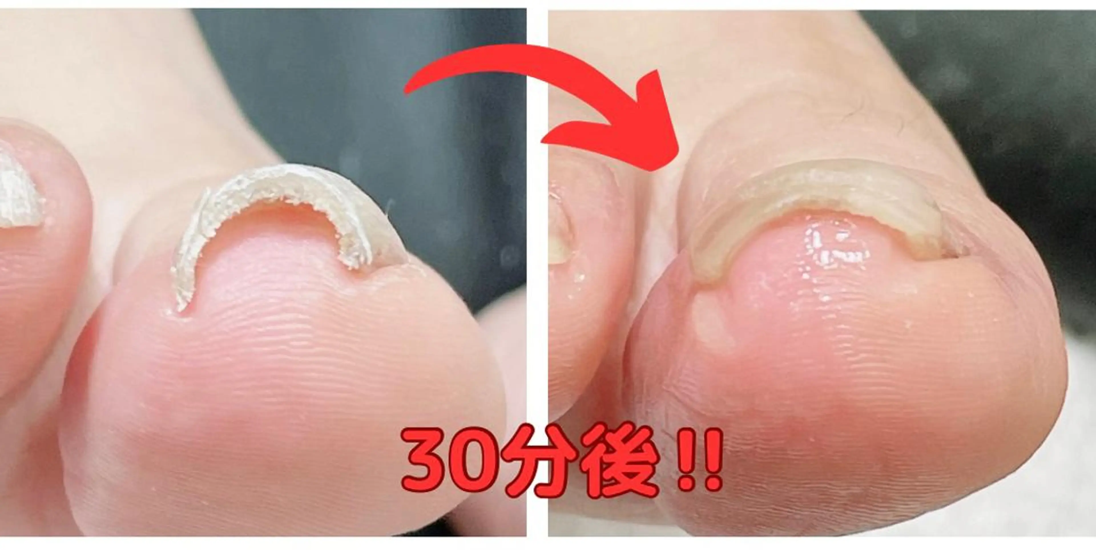 ネイル 深爪・巻き爪 専門サンセリテのネイルデザイン