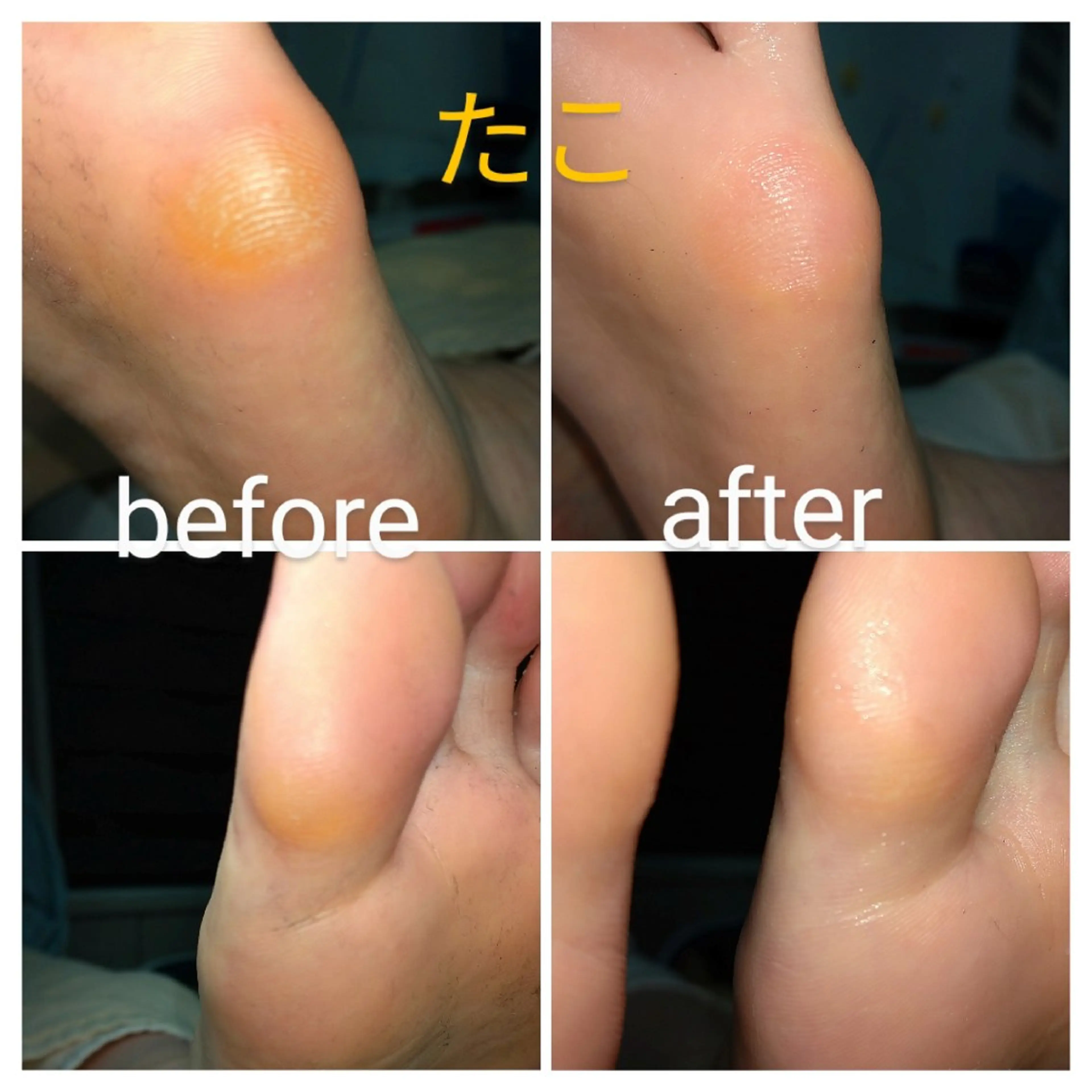 巻き爪補正店 大阪なんば店のネイルデザイン