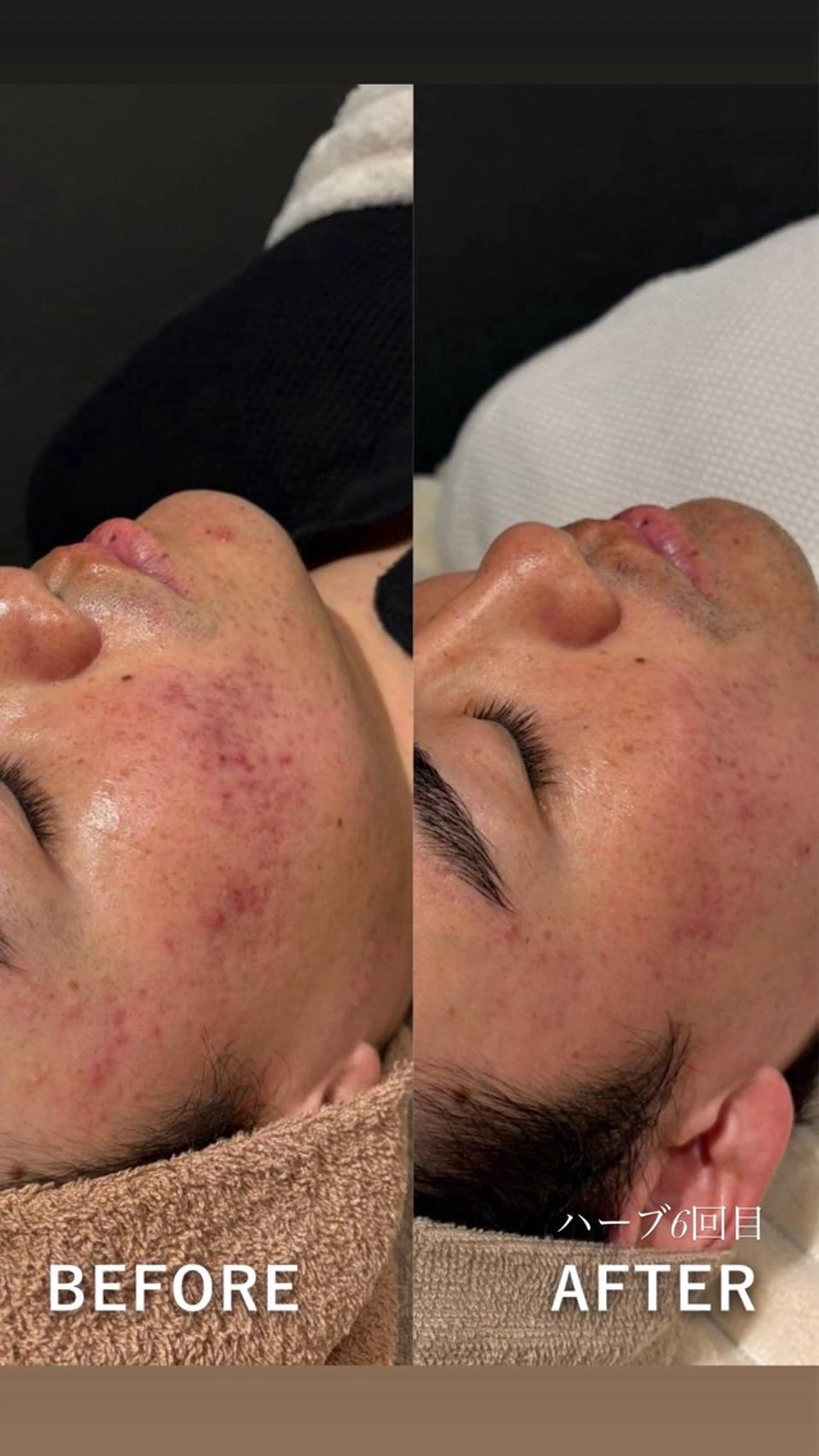 【肌質底上げ🌿】ハーブピーリングの写真