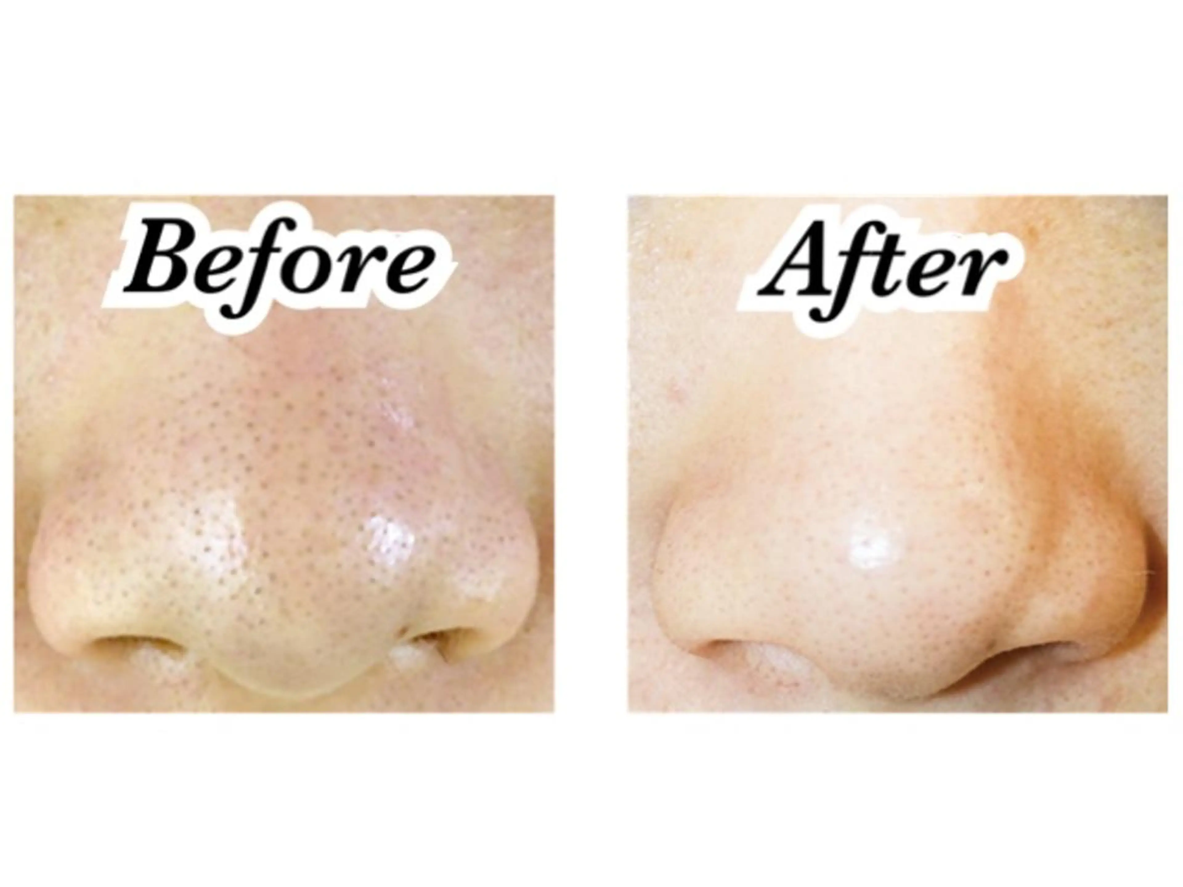 【毛穴ふわもこ洗浄】マスクによるお肌トラブル！ニキビ肌に！毛穴スッキリお掃除✨お化粧ノリもばっちり👌🏻♪の写真