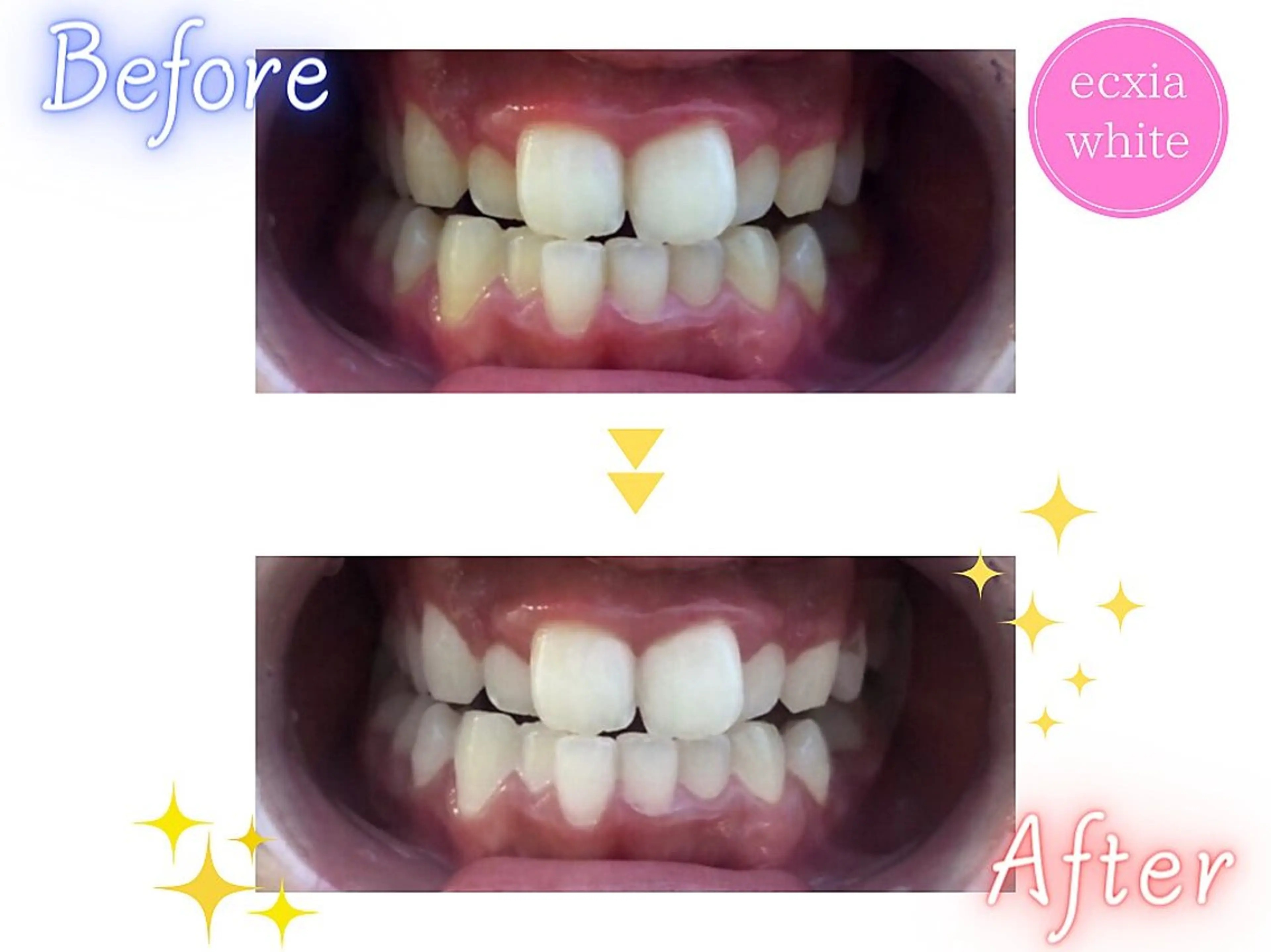 その他 セルフホワイトニング chii🎀のその他イメージ