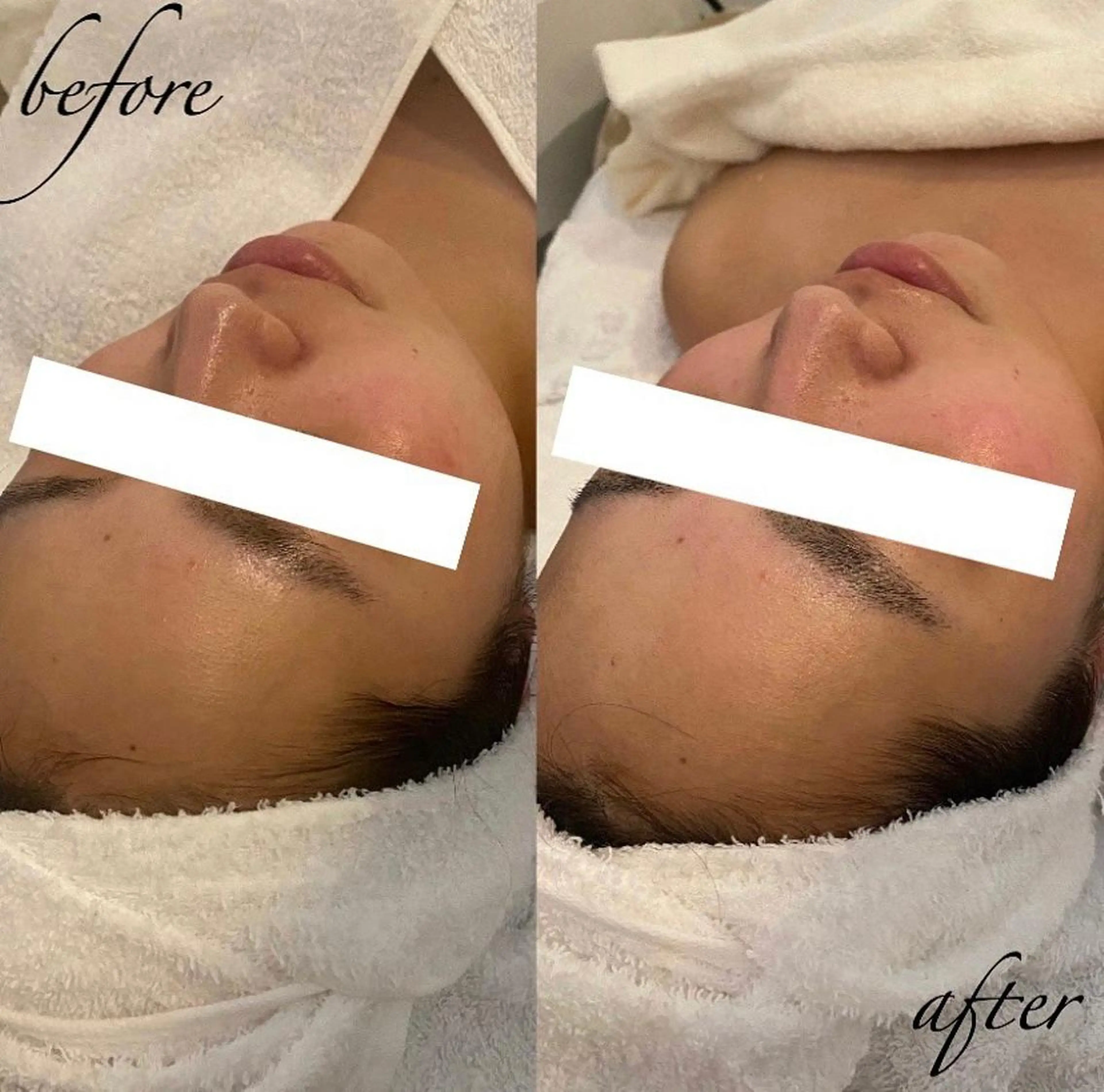 韓国/ピーリング 毛穴洗浄/POLAのエステ・リラクイメージ