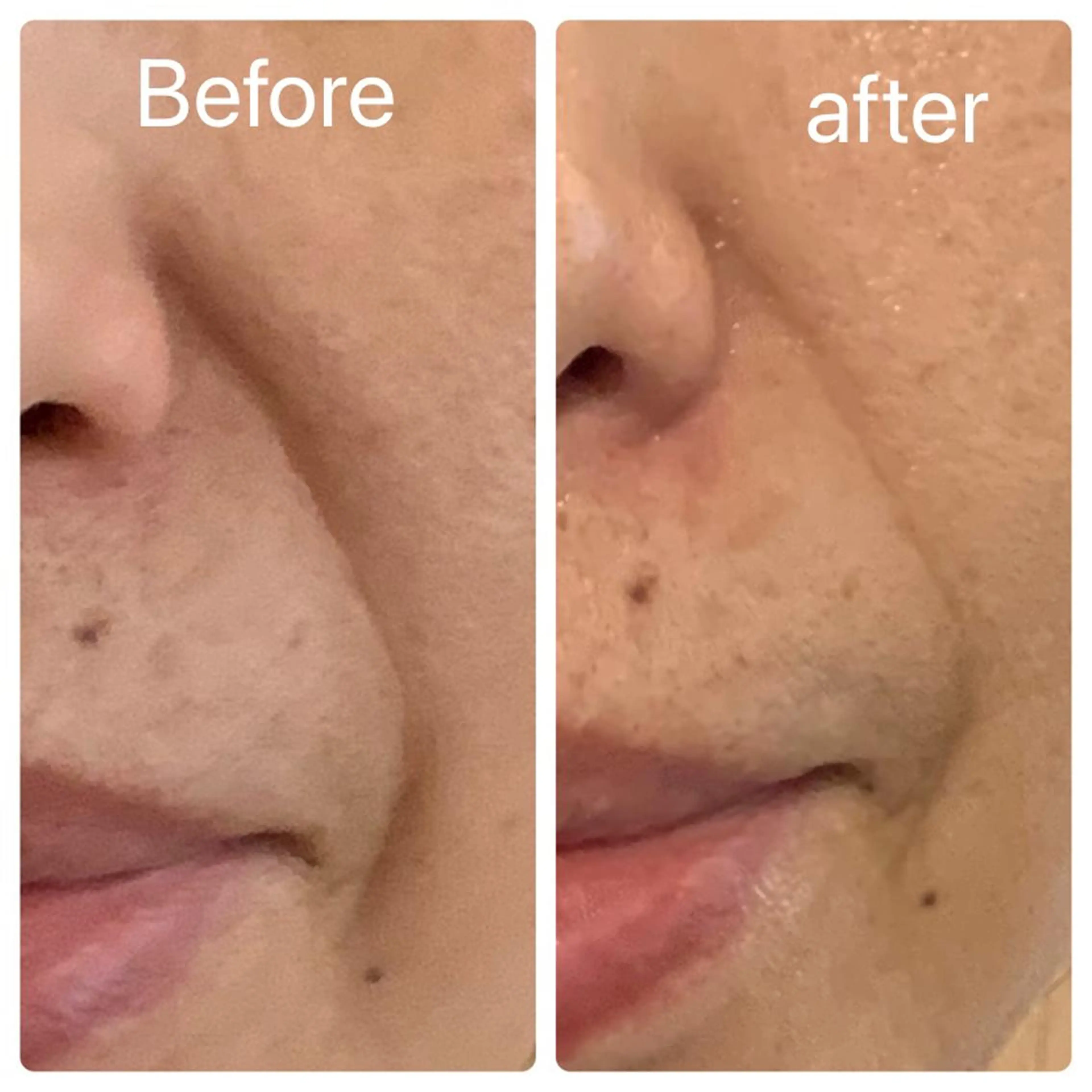 🌈変化感動率100%✨シワ、たるみ、毛穴撃退‼︎速攻引き上げ❣️エステ💆‍♀️メンズも歓迎👨の写真