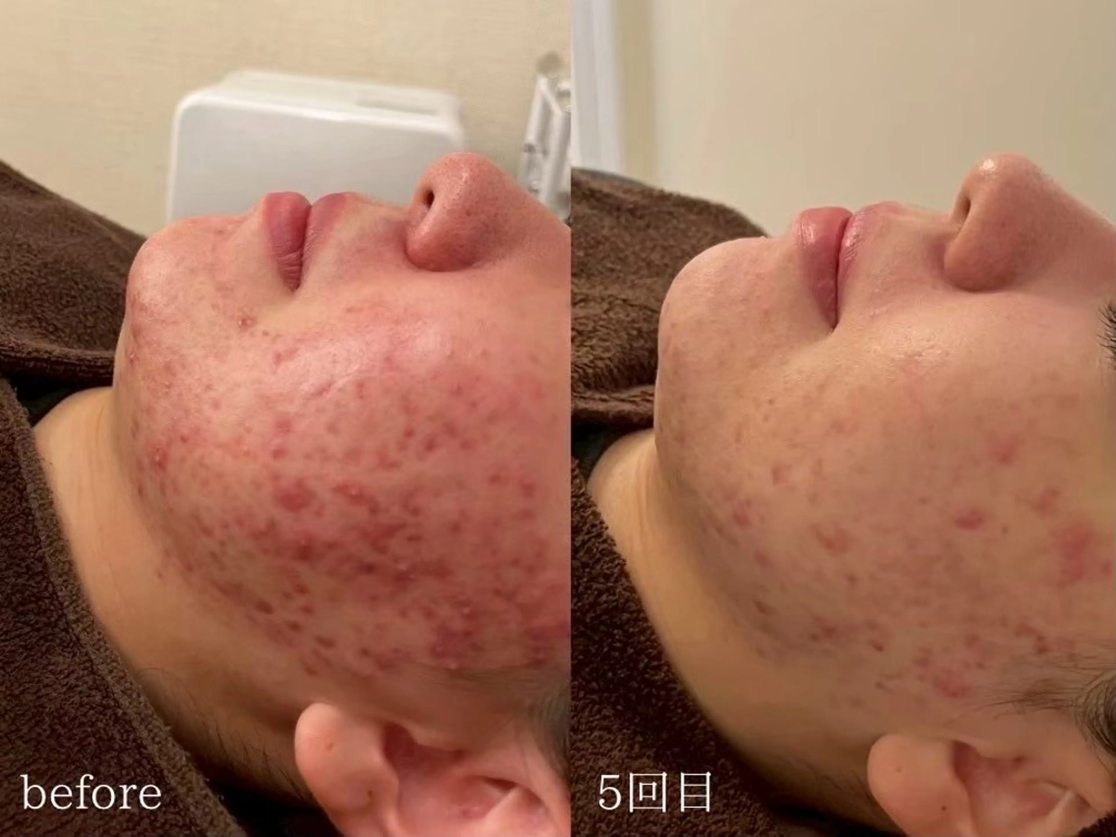 eto. ニキビ・ニキビ跡のエステ・リラクイメージ