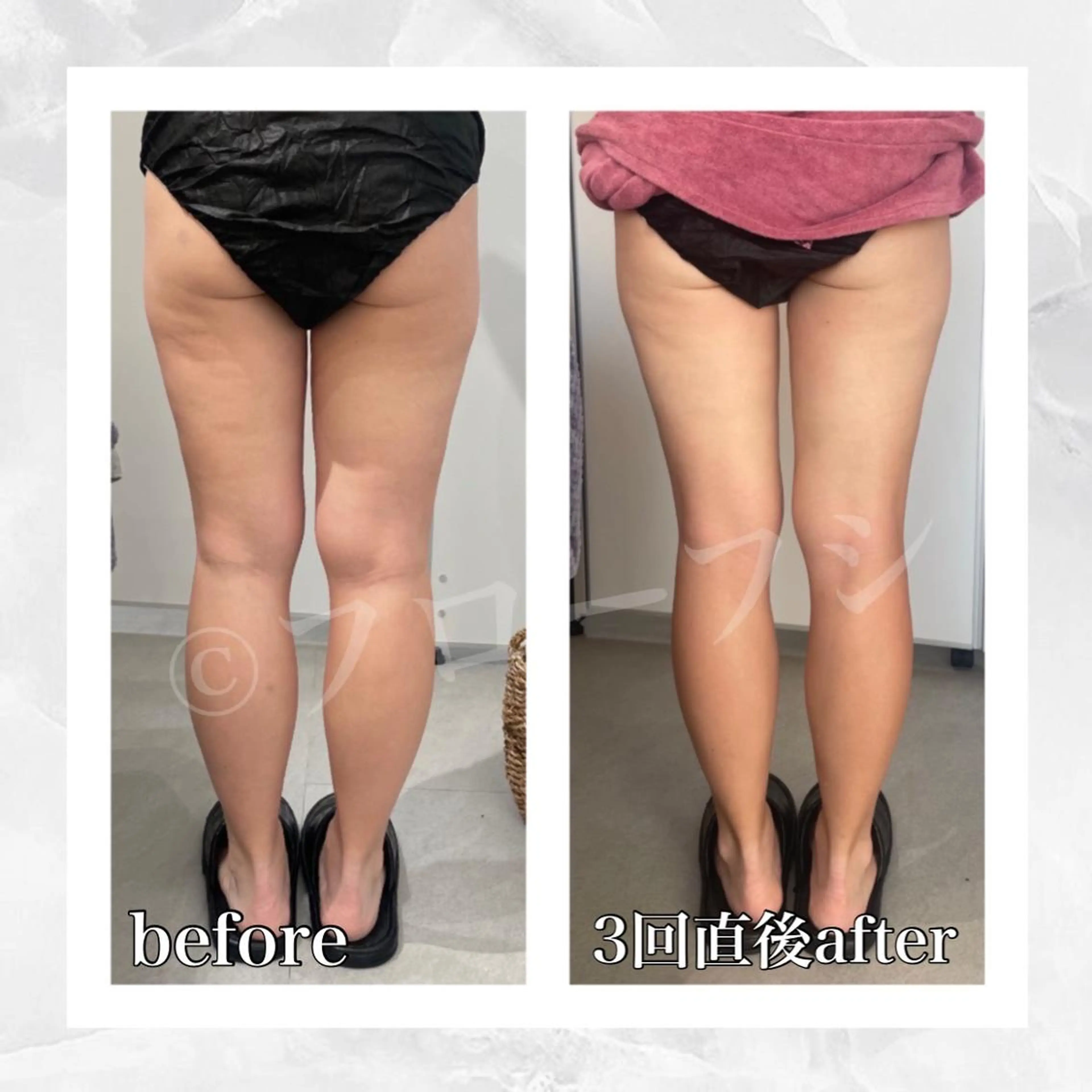 エステ リラク 部分痩せ♥️小顔専門 MIKUのエステ・リラクイメージ