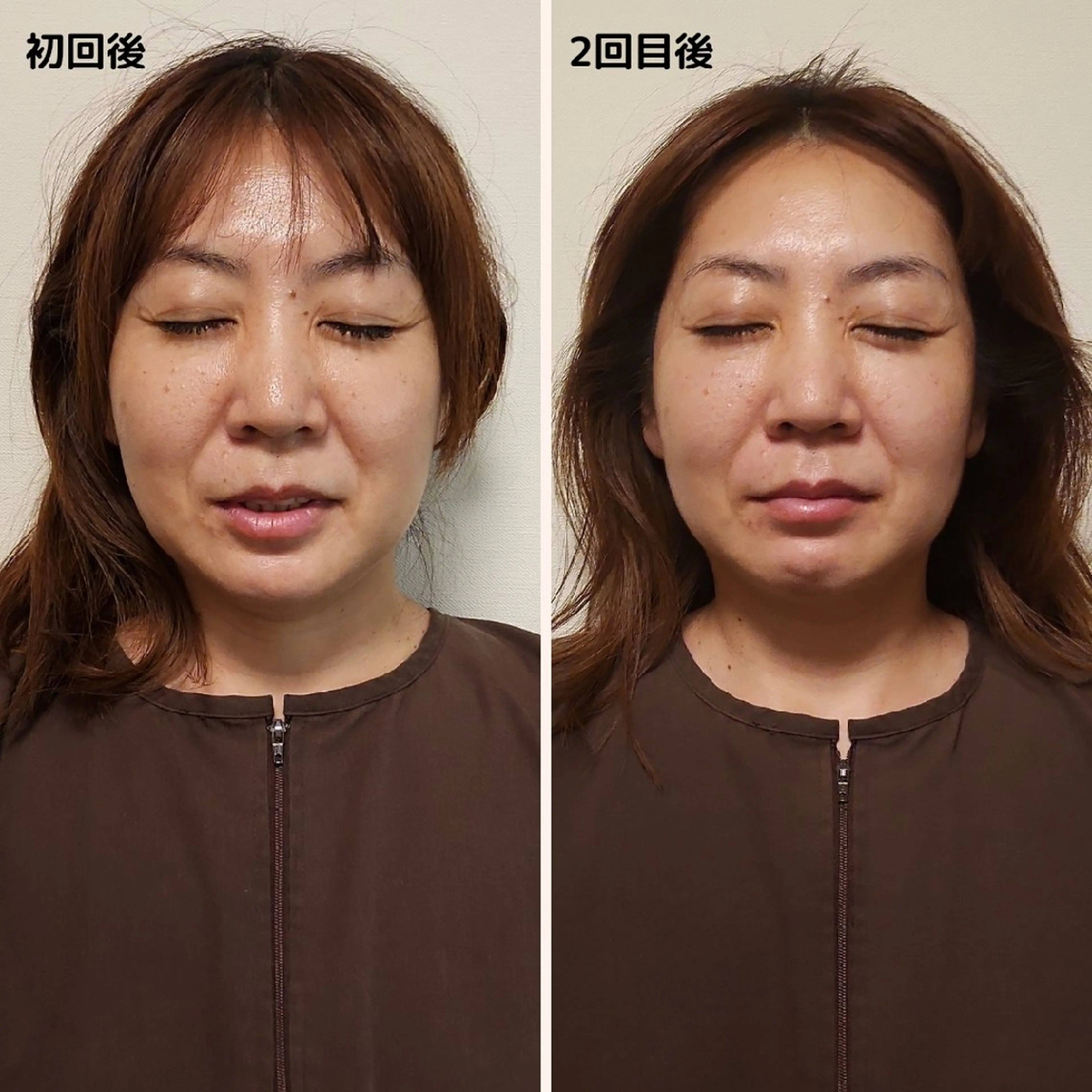 即効⚡小顔美容鍼🪡 むくみたるみ脂肪解消のエステ・リラクイメージ