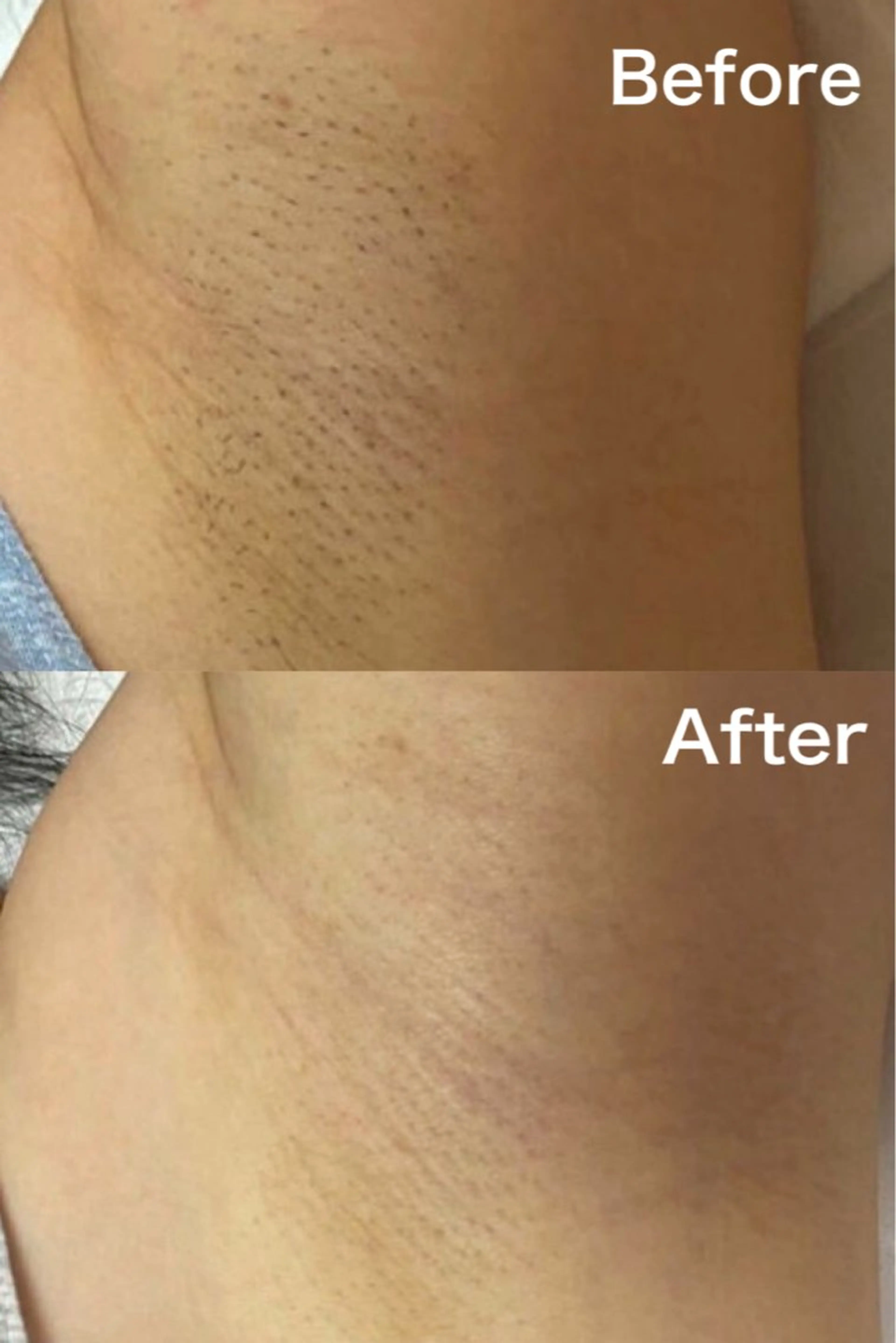 【初回限定】ワキ脱毛体験 カウンセリング込みの写真