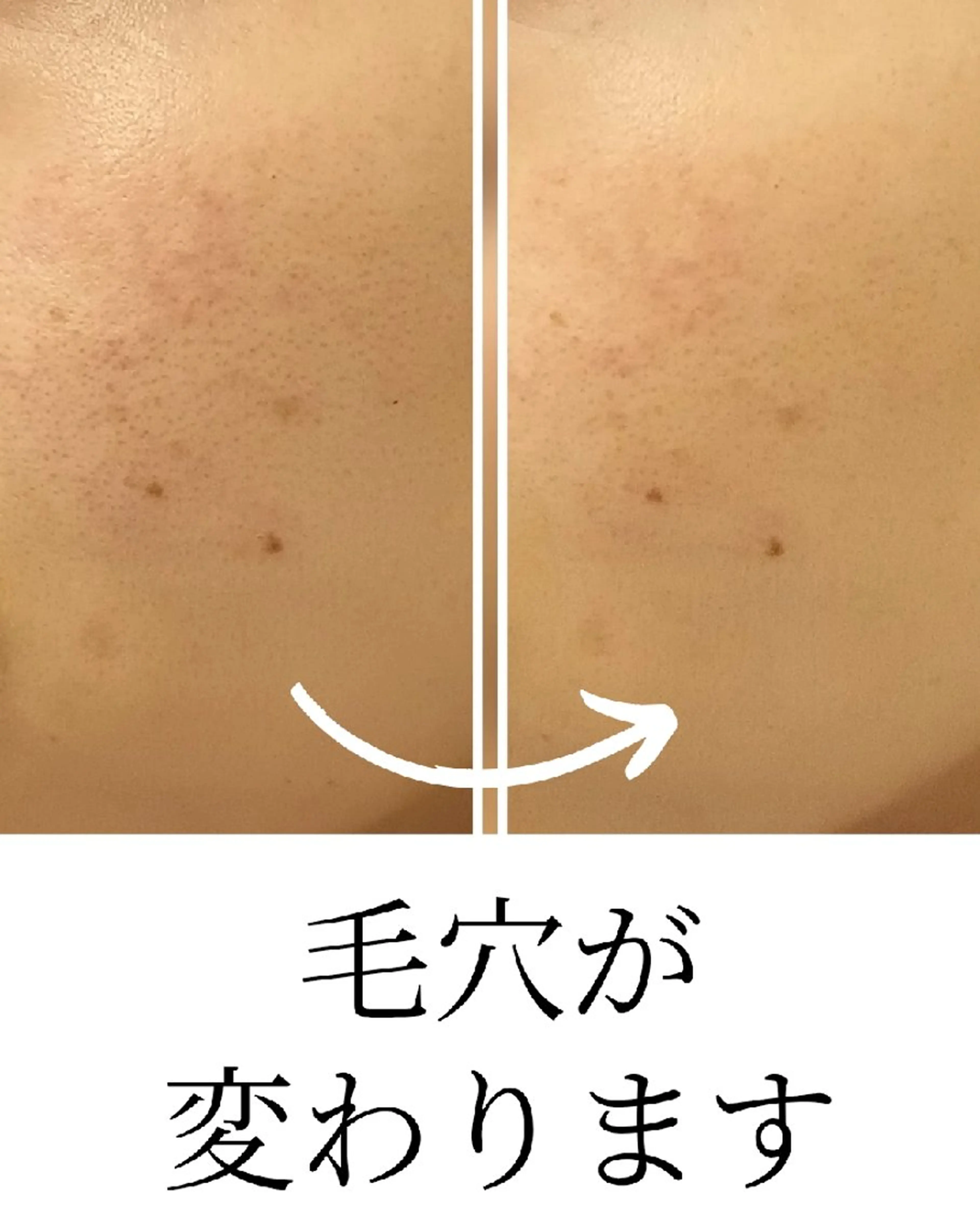 水光肌ピーリング ハーブピーリングのエステ・リラクイメージ