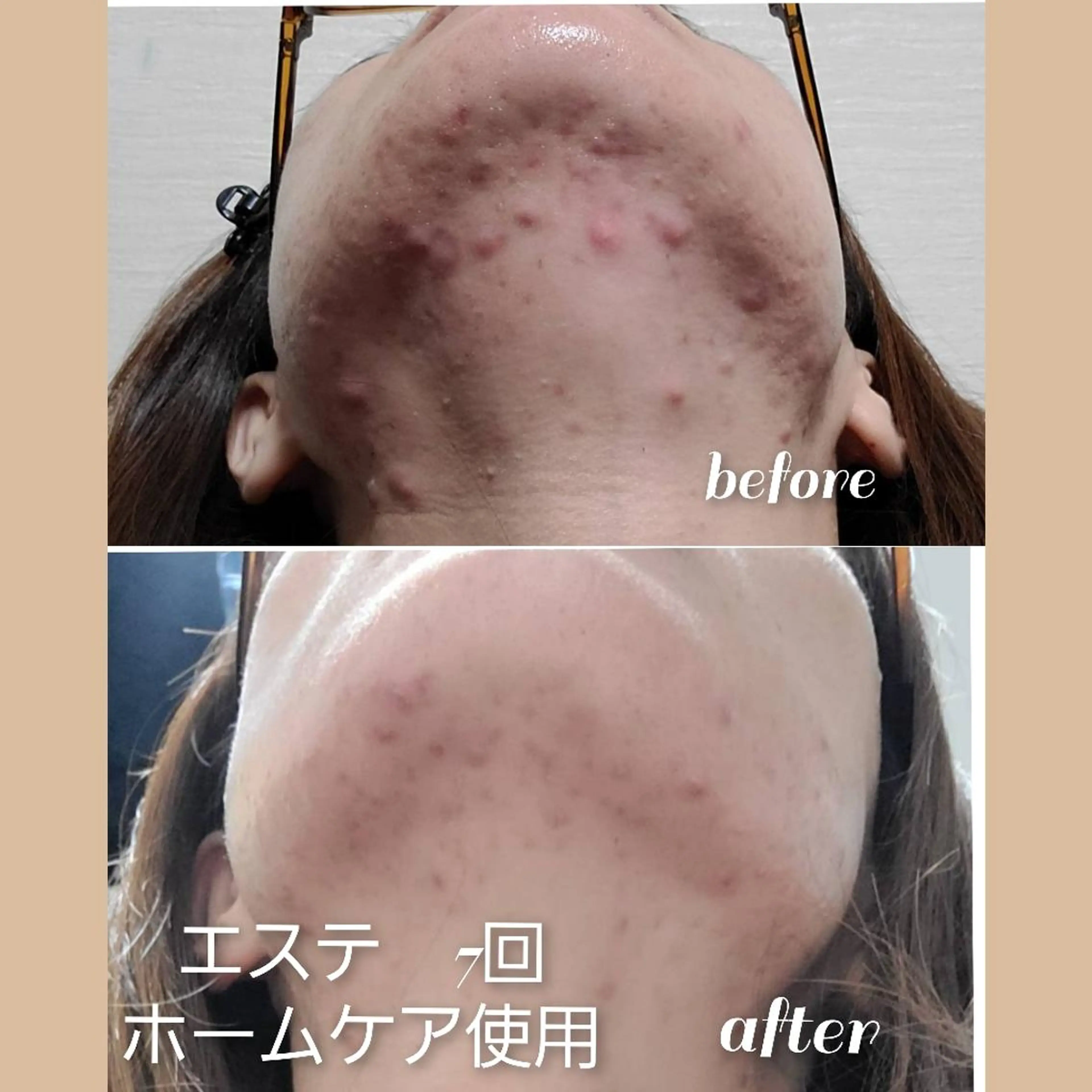 デ・アイム王寺所属・肌改善エミリーノ 米田真美子のエステ・リラクイメージ