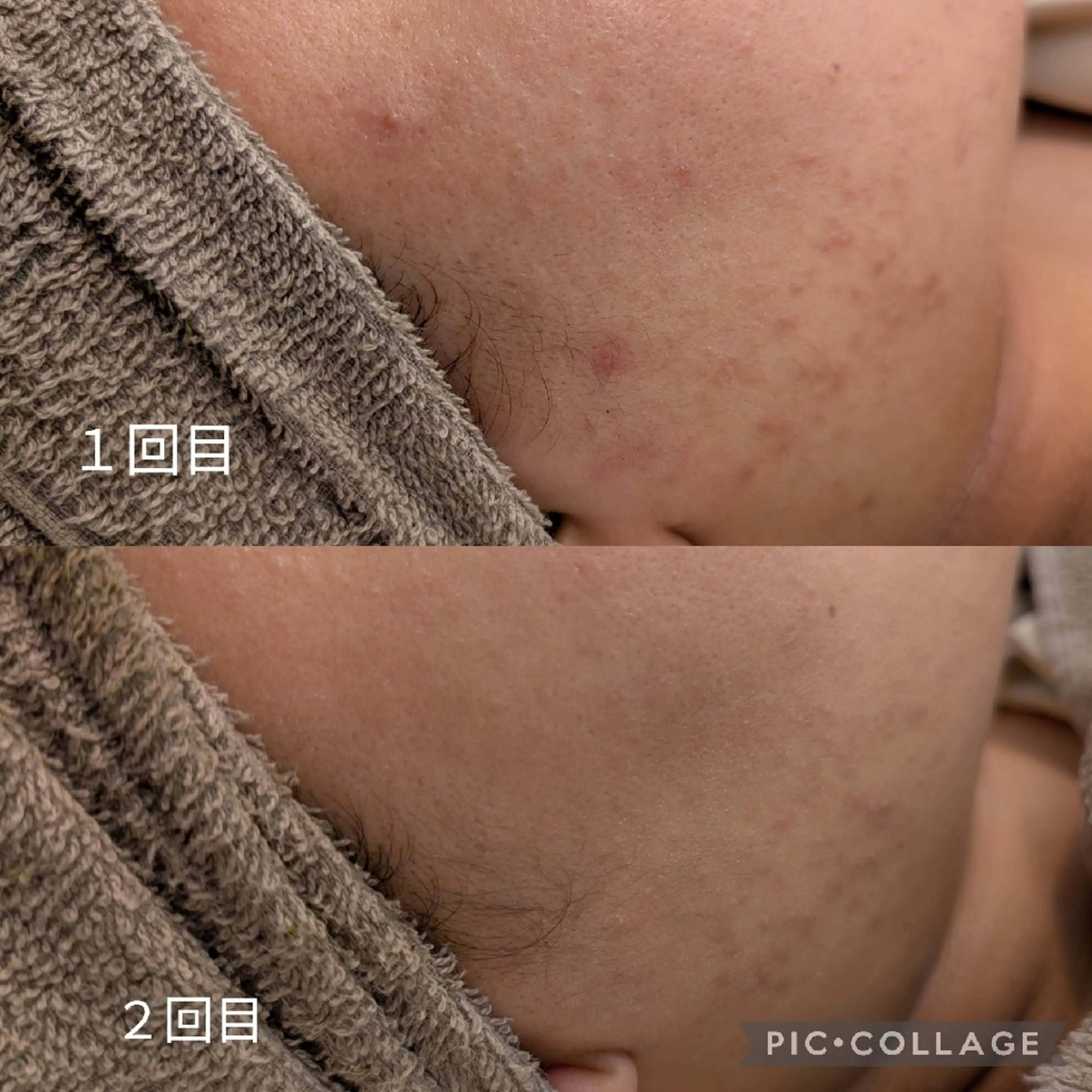 エステ 【毛穴ハーブピーリン グ】板橋1位のエステ・リラクイメージ