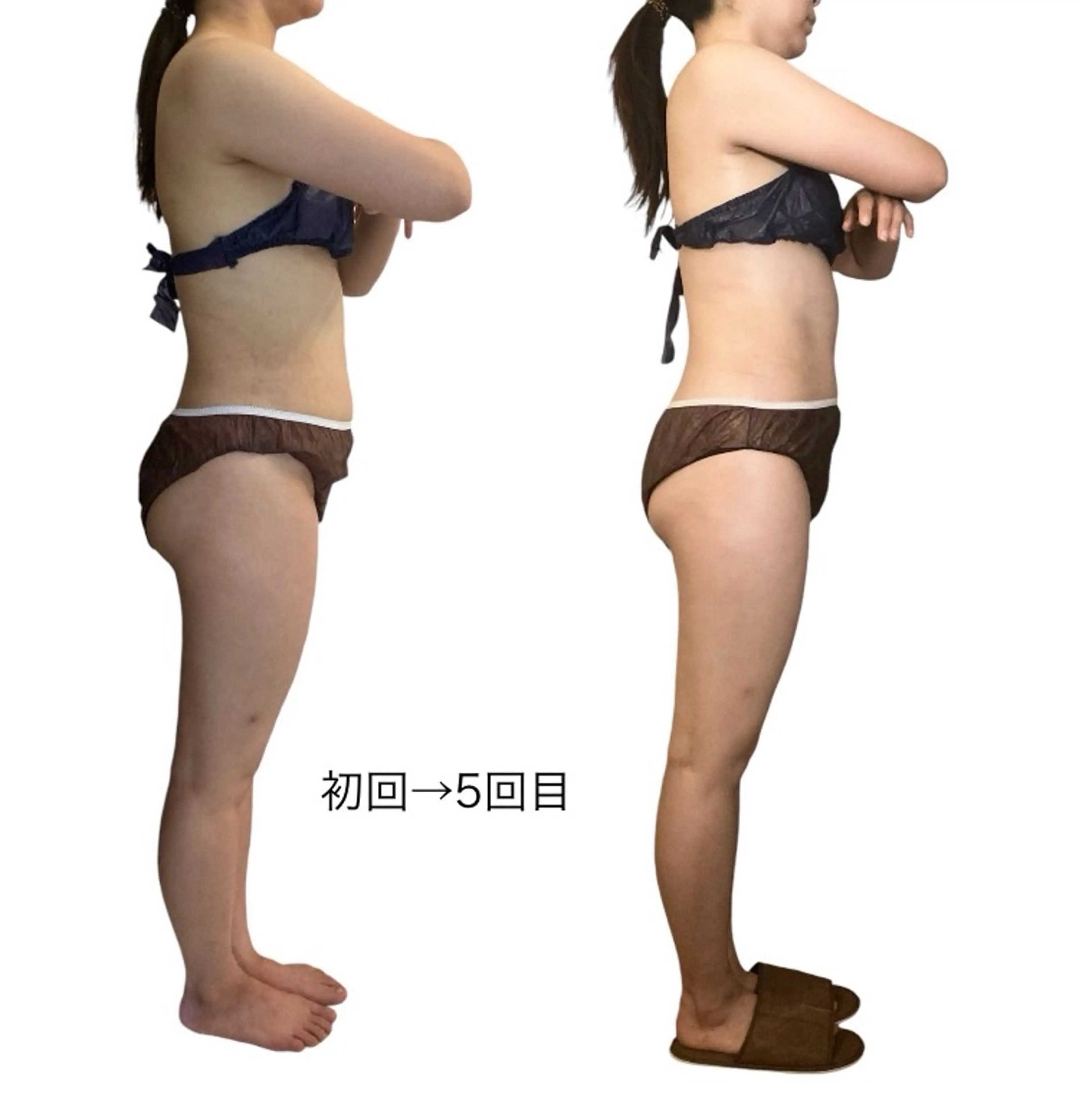 【1ヶ月フリーパスご利用の方のみ限定価格】ラジオ波で緩めた身体を深部筋膜リリースの写真