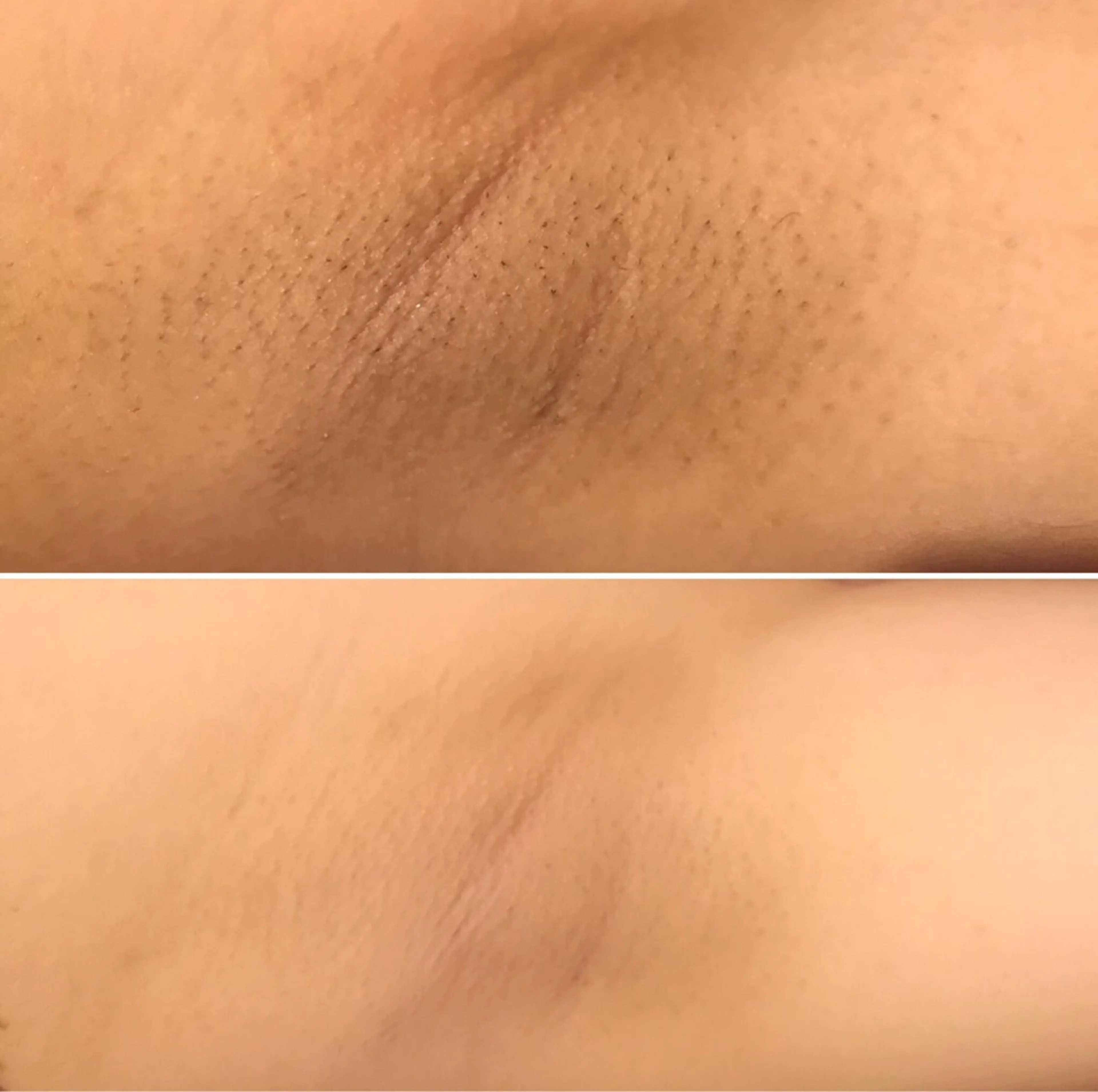 レディス【ワキ・脱毛】当日予約不可❌脱毛しながら、美肌効果も抜群💖の写真