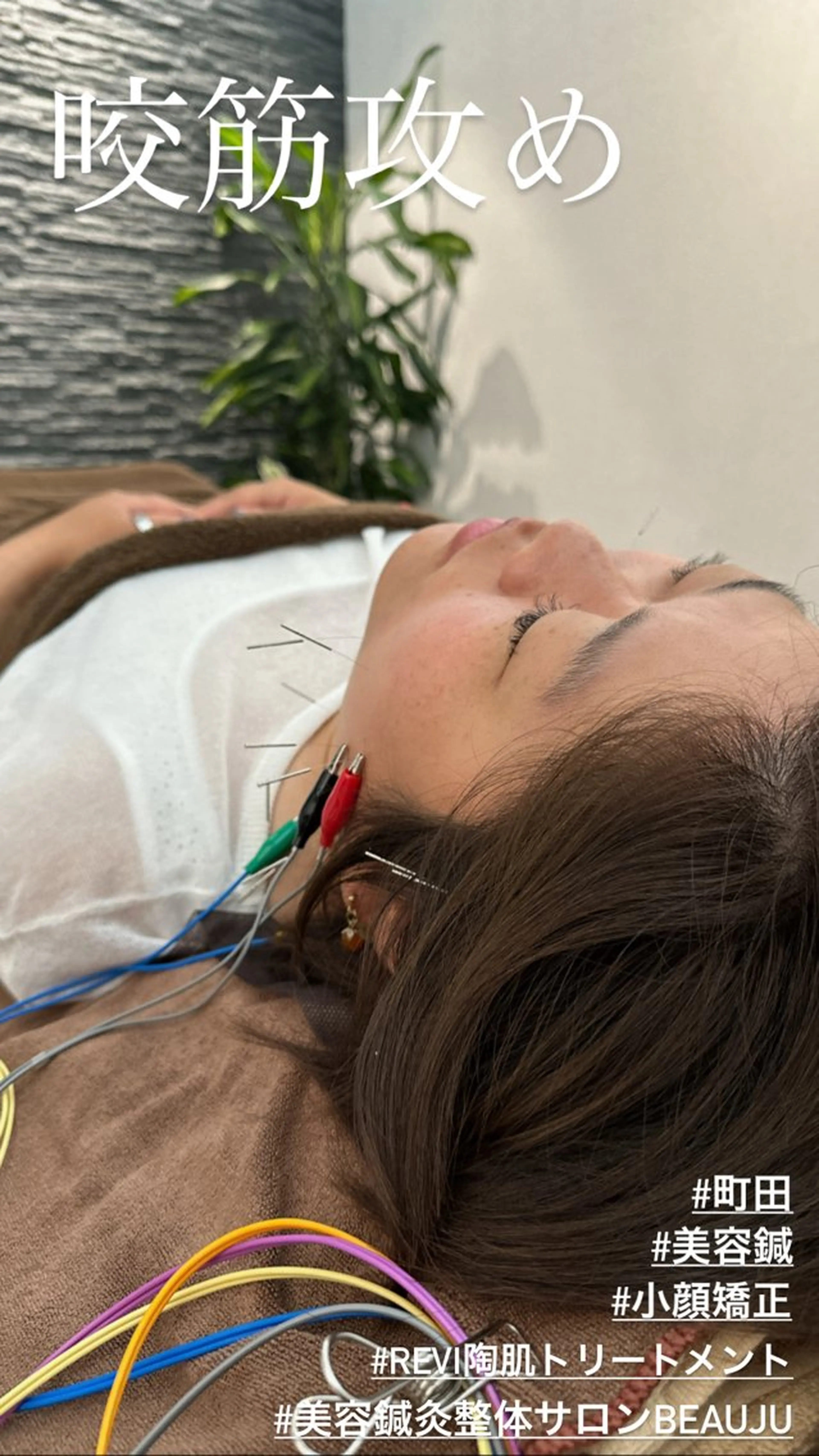 その他 小顔矯/美容鍼/鍼灸 BeauJuのその他イメージ