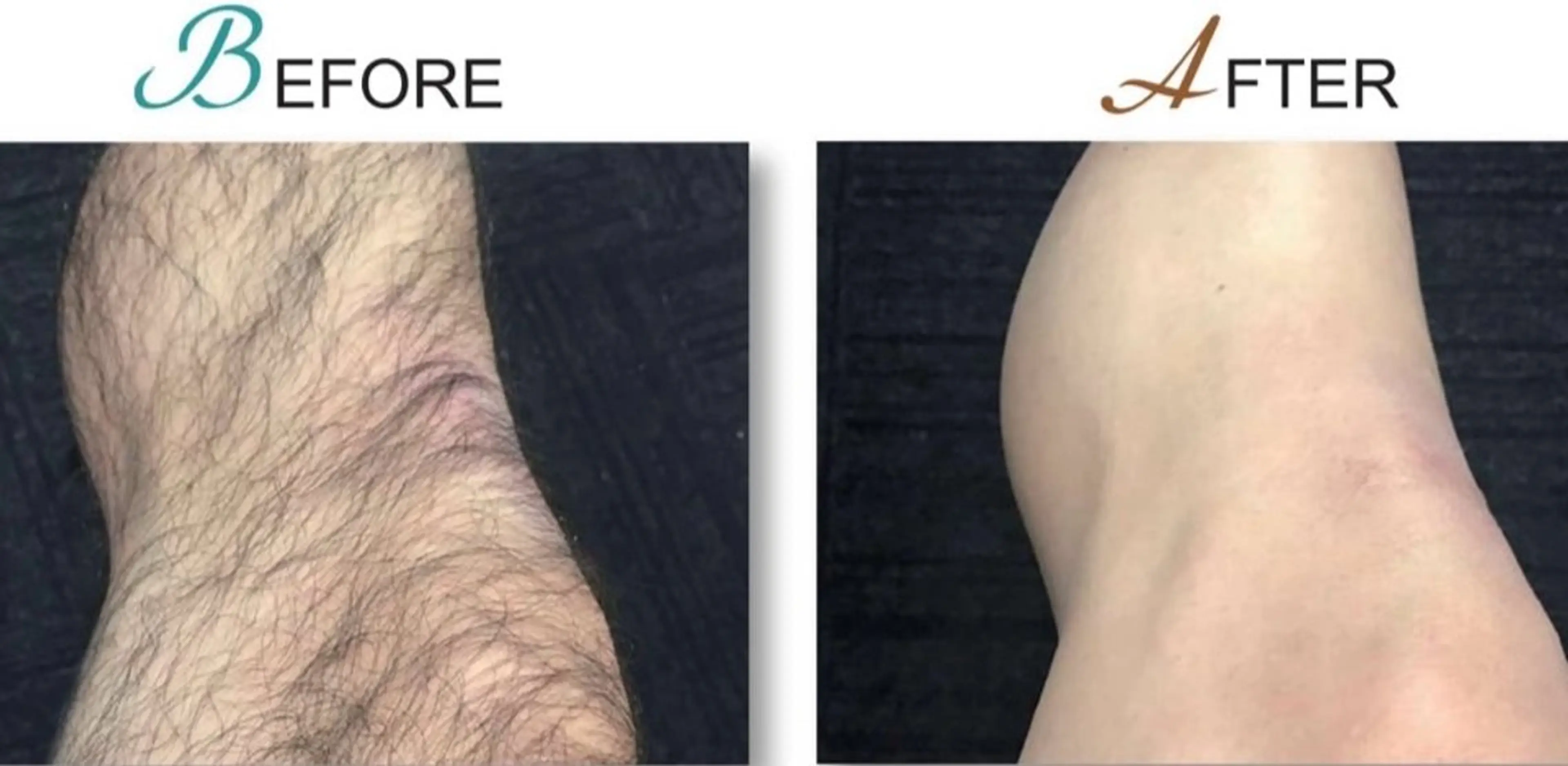 【メンズ人気♠️】ベーシックセット（ヒゲ、ひざ下、ワキ）の写真