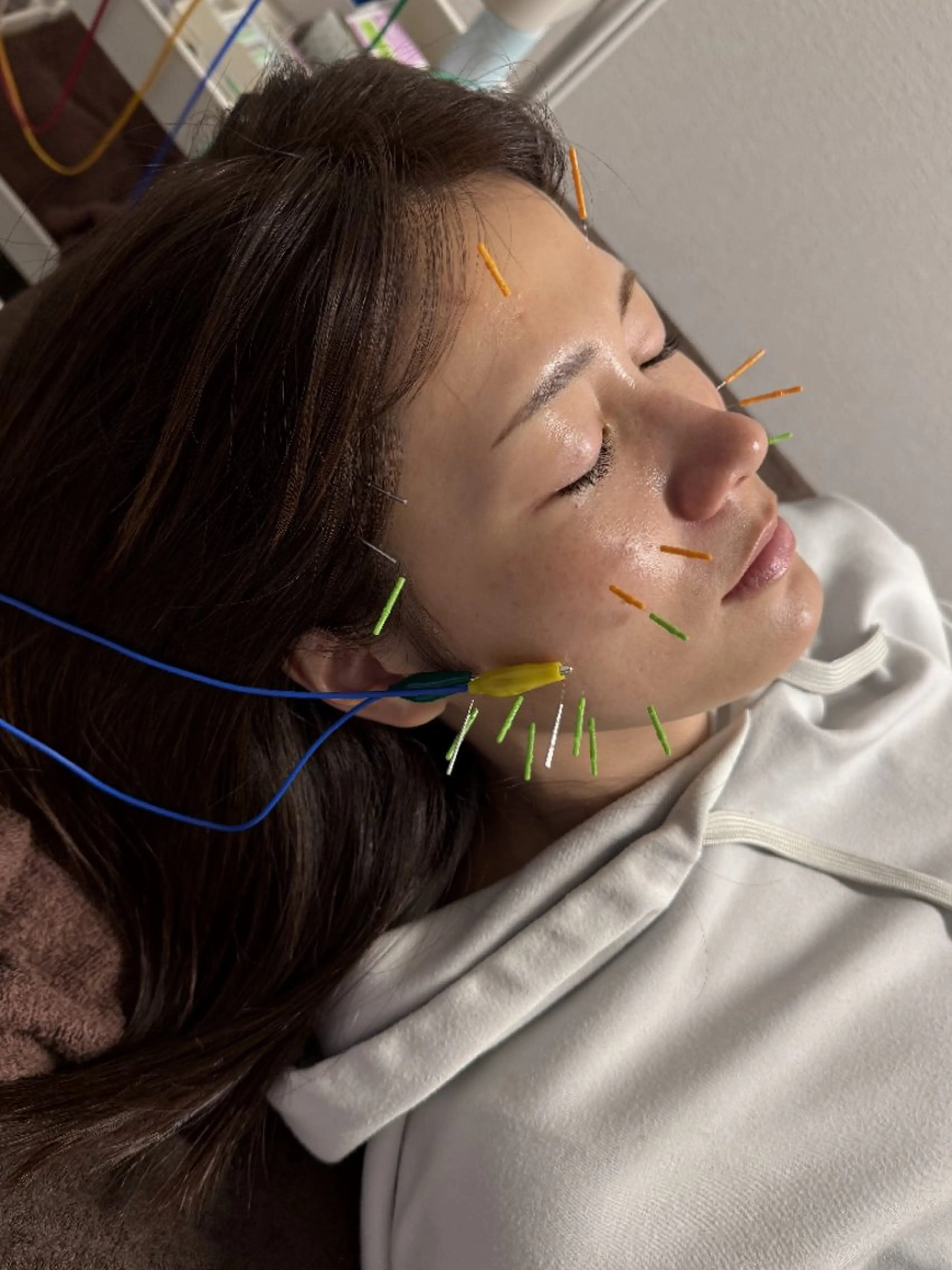 🩷ミニモ限定🩷電気美容鍼＋小顔矯正＋首肩マッサージの写真