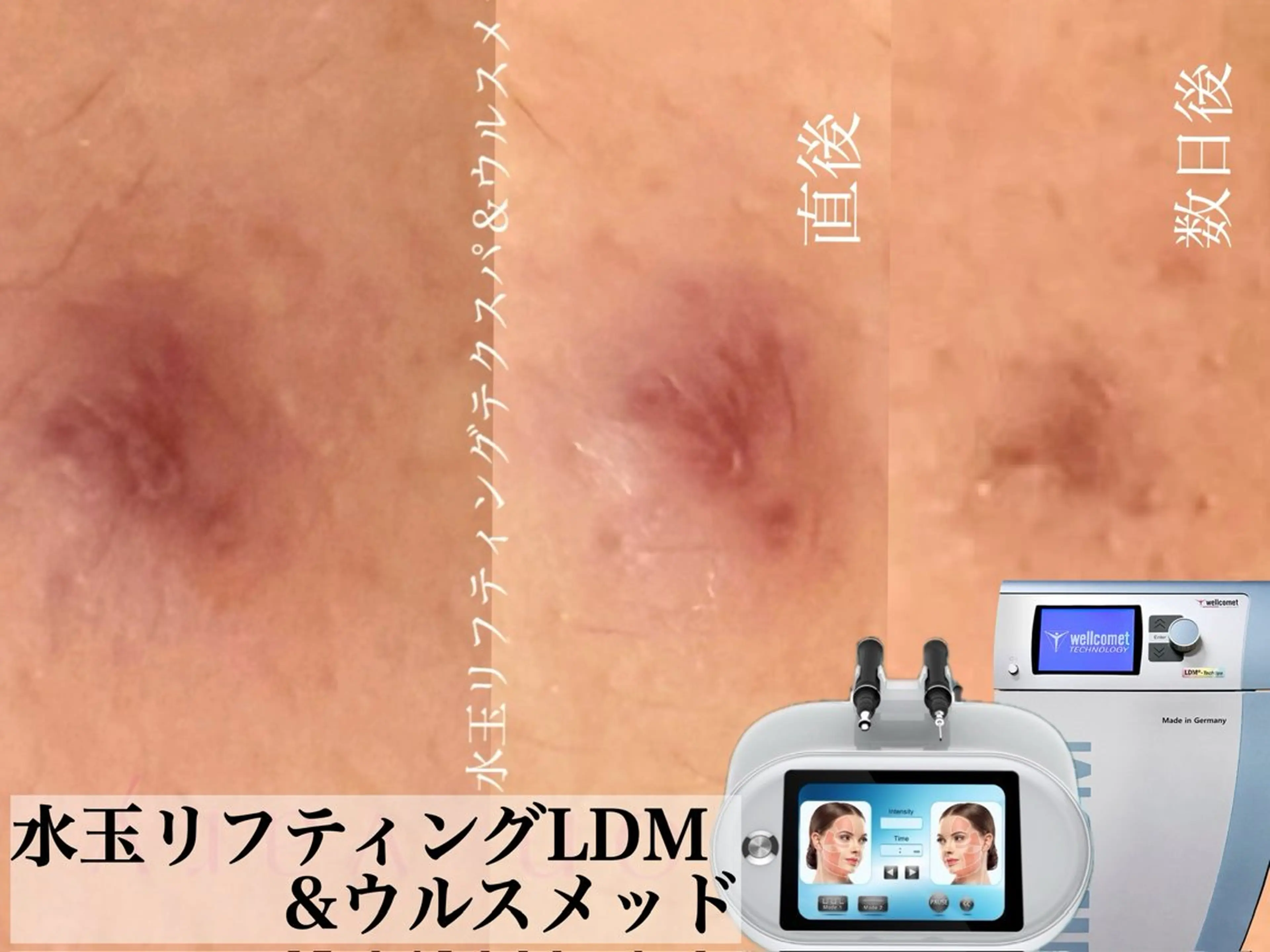 ニキビ•ニキビ跡改善 salon varyのエステ・リラクイメージ