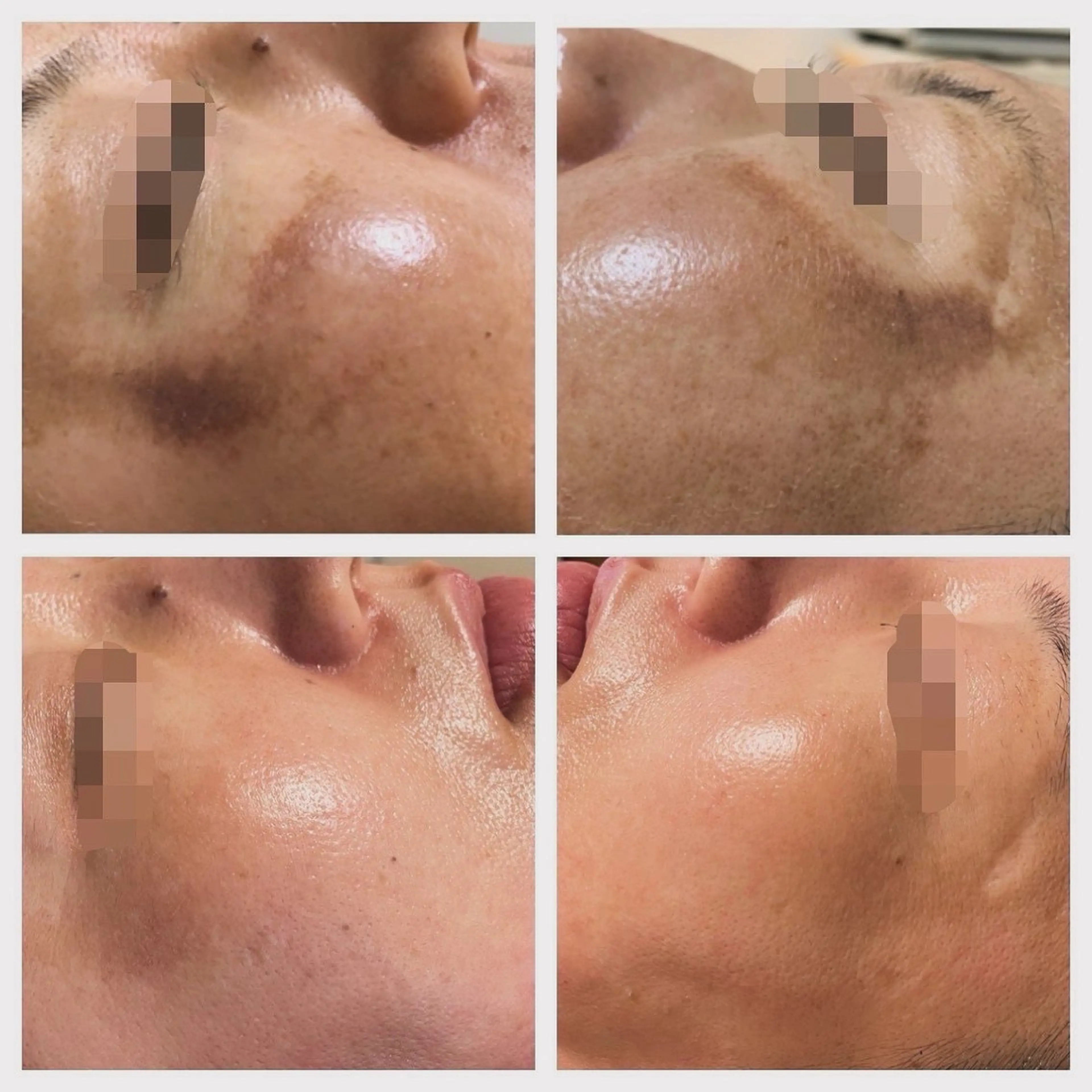 ハーブピーリング 美肌サロン　makiのエステ・リラクイメージ